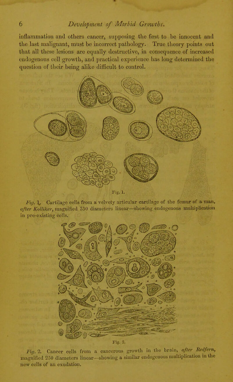 inflammation and others cancer, supposing the first to he innocent and the last malignant, must be incorrect pathology. True theory points out that all these lesions are equally destructive, in consequence of increased endogenous cell growth, and practical experience lias long determined the question of their being alike difficult to control. Fig. \, Cartilage cells from a velvety articular cartilage of the femur of a man, after Kolliker, magnified 350 diameters linear—showing endogenous multiplication in pre-existing cells. Fig. 2. Fiy.2. Cancer cells from a cancerous growth in the brain, after Reafcrn, magnified 250 diameters linear—showing a similar endogenous multiplication in the now cells of an exudation.