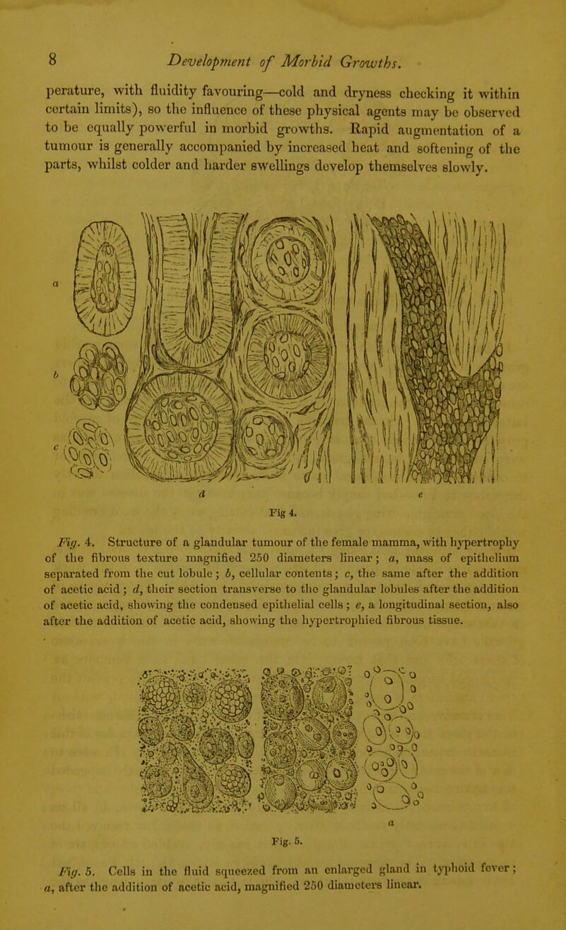 perature, with fluidity favouring—cold and dryness checking it within certain limits), so the influence of these physical agents may be observed to be equally powerful in morbid growths. Rapid augmentation of a tumour is generally accompanied by increased heat and softening of the parts, whilst colder and harder swellings develop themselves slowly. d c Fig 4. Fig. 4. Structure of a glandular tumour of the female mamma, with hypertrophy of the fibrous texture magnified 250 diameters linear; a, mass of epithelium separated from the cut lobule; b, cellular contents; c, the same after the addition of acetic acid ; d, their section transverse to the glandular lobules after the addition of acetic acid, showing the condensed epithelial cells; e, a longitudinal section, also after the addition of acetic acid, showing the hypertrophied fibrous tissue. Fig. 5. Fig. 5. Cells in the fluid squeezed from an enlarged gland in typhoid fever; a, after the addition of acetic acid, magnified 250 diameters linear.