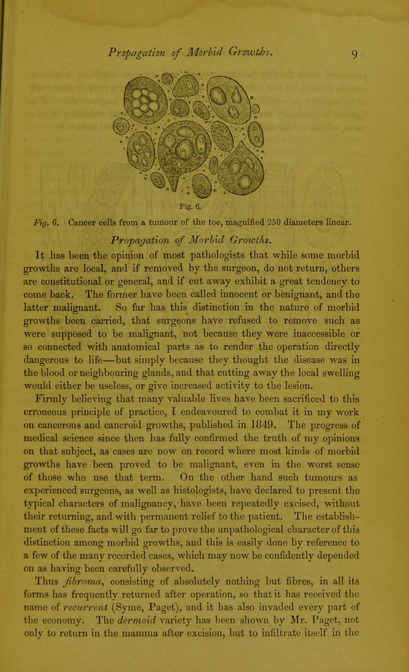 Fig. 6. Fig. 6. Cancer cells from a tumour of the toe, magnified 250 diameters linear. Propagation of Morbid Growths. It has been the opinion of most pathologists that while some morbid growths are local, and if removed by the surgeon, do not return, others are constitutional or general, and if cut away exhibit a great tendency to come back. The former have been called innocent or benignant, aud the latter malignant. So far has this distinction in the nature of morbid growths been carried, that surgeons have refused to remove such as were supposed to be malignant, not because they were inaccessible or so connected with anatomical parts as to render the operation directly dangerous to life—but simply because they thought the disease was in the blood or neighbouring glands, and that cutting away the local swelling would either be useless, or give increased activity to the lesion. Firmly believing that many valuable lives have been sacrificed to this erroneous principle of practice, I endeavoured to combat it in my work on cancerous and cancroid growths, published in 1849. The progress of medical science since then has fully confirmed the truth of my opinions on that subject, as cases are now on record where most kinds of morbid growths have been proved to be malignant, even in the worst sense of those who use that term. On the other hand such tumours as experienced surgeons, as well as histologists, have declared to present the typical characters of malignancy, have been repeatedly excised, without their returning, and with permanent relief to the patient. The establish- ment of these facts will go far to prove the unpathological character of this distinction among morbid growths, and this is easily done by reference to a few of the many recorded cases, which may now be confidently depended on as having been carefully observed. Thus fibroma, consisting of absolutely nothing but fibres, in all its forms has frequently returned after operation, so that it has received the name of recurrent (Syme, Paget), and it has also invaded every part of the economy. The dermoid variety has been shown by Mr. Paget, not only to return in the mamma after excision, but to infiltrate itself in the