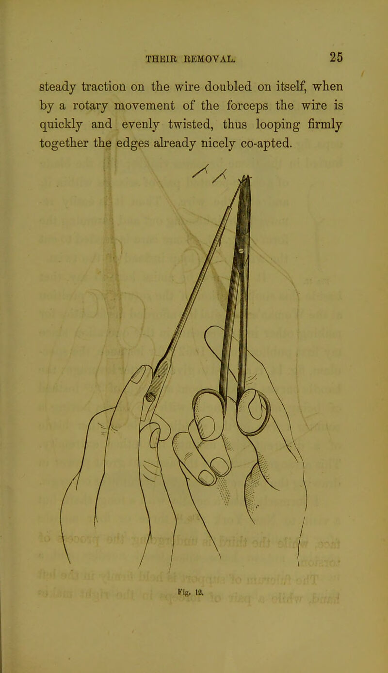 steady traction on the wire doubled on itself, when by a rotary movement of the forceps the wire is quickly and evenly twisted, thus looping firmly together the edges already nicely co-apted. Fig. 12.