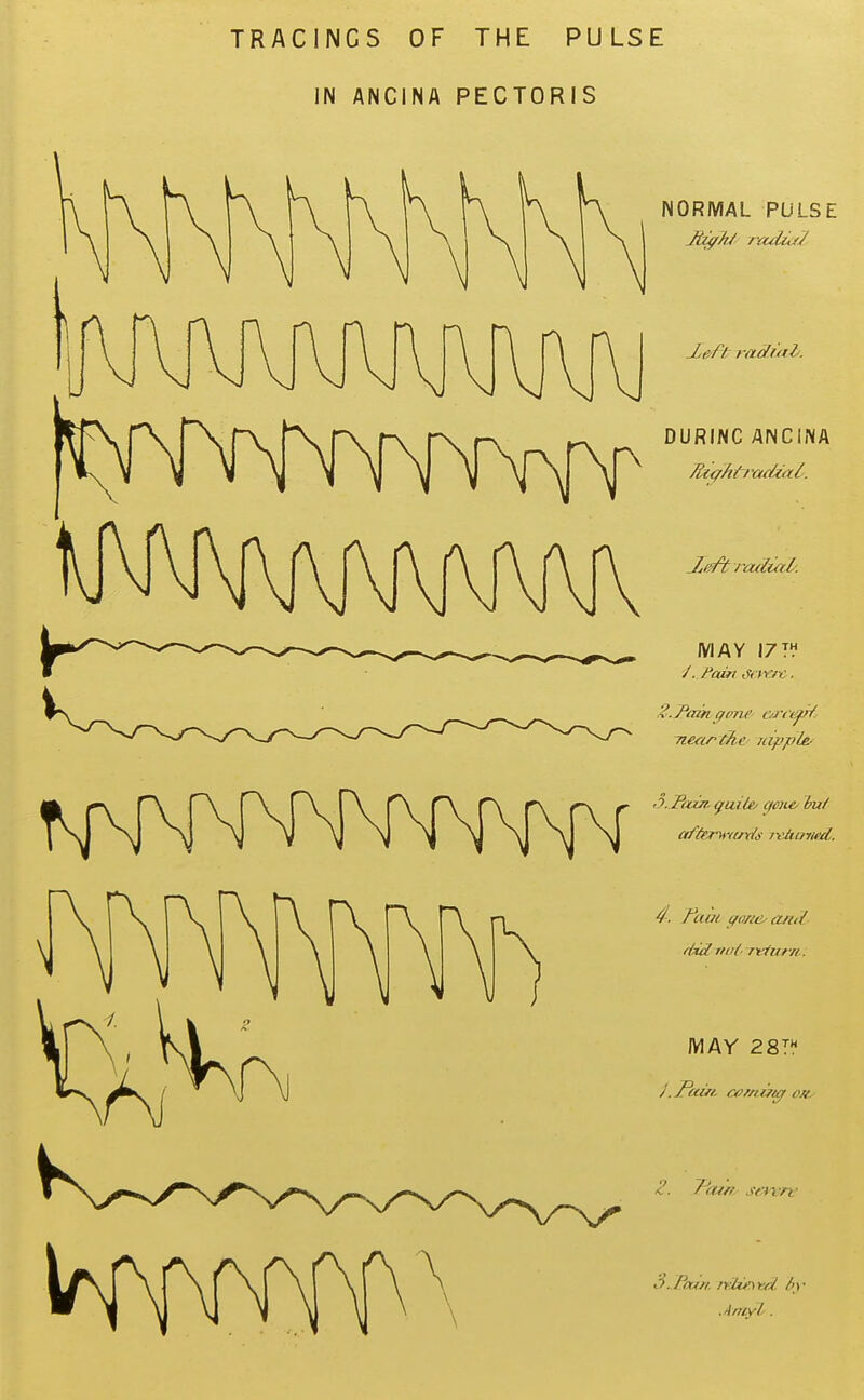 TRACINGS OF THE PULSE IN ANGINA PECTORIS NORMAL PULSE Xerft raduti/. DURING ANGINA MAY 17 T^* 4. /ciat (fo/a>^ and MAY 281^* /, Paifi. (xmifuf on^ .Aniyl.