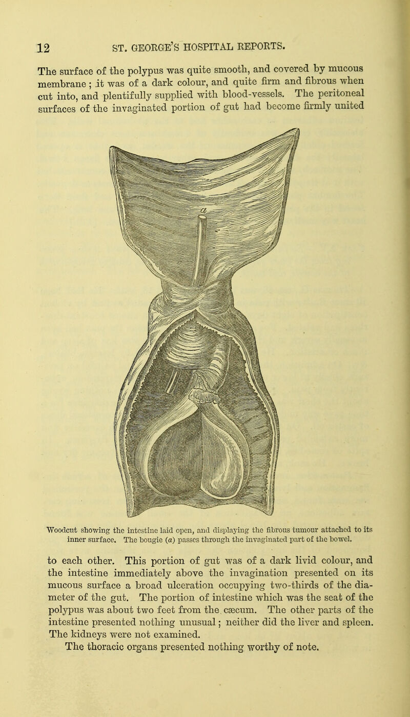 The surface of the polypus was quite smooth, and covered by mucous membrane; it was of a dark colour, and quite firm and fibrous when cut into, and plentifully supplied with blood-vessels. The peritoneal surfaces of the invaginated portion of gut had become firmly united Woodcut showing the intestine laid open, and displaying the fibrous tumour attached to its inner surface. The bougie (a) passes through the invaginated part of the bowel. to each other. This portion of gut was of a dark livid colour, and the intestine immediately above the invagination presented on its mucous surface a broad ulceration occupying two-thirds of the dia- meter of the gut. The portion of intestine which was the seat of the polypus was about two feet from the. caecum. The other parts of the intestine presented nothing unusual; neither did the liver and spleen. The kidneys were not examined. The thoracic organs presented nothing worthy of note.