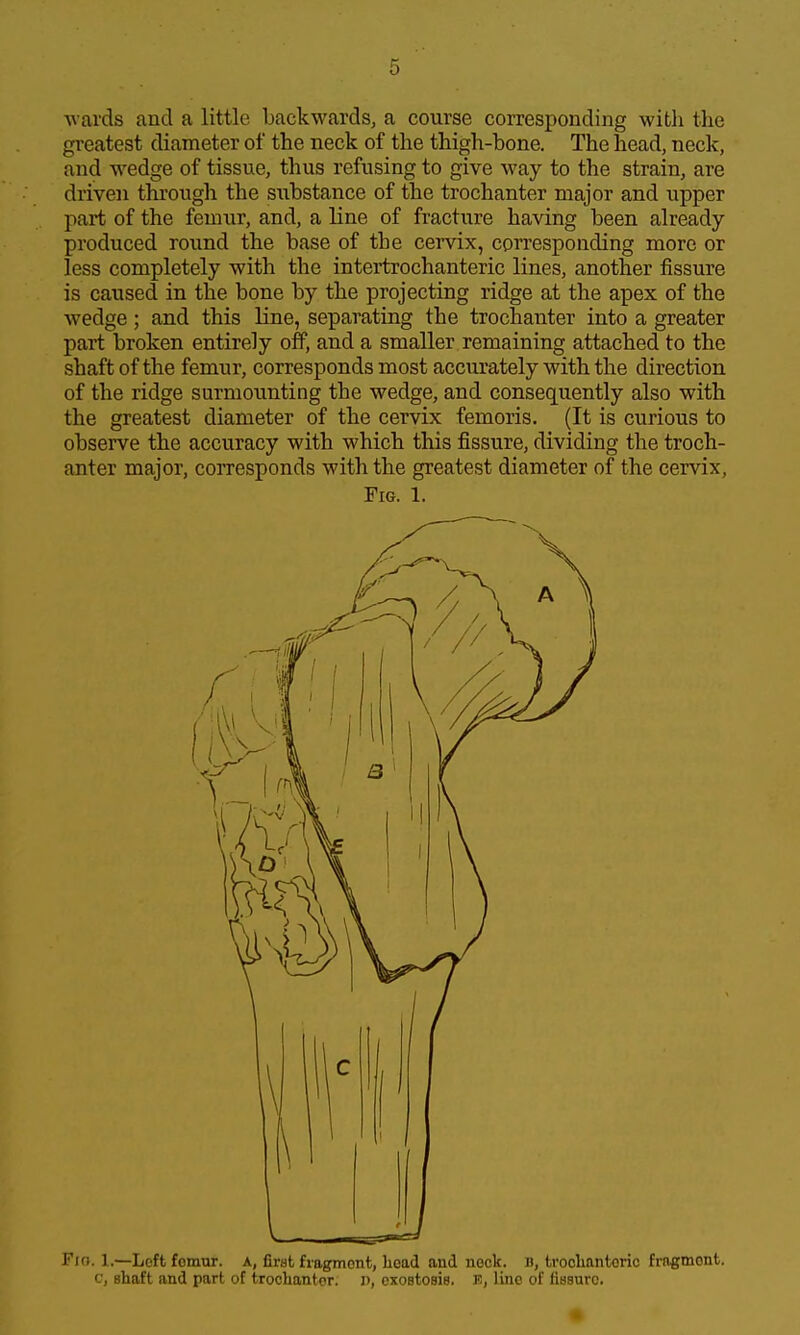 ■vA-ards and a little backwards, a course corresponding with the greatest diameter of the neck of the thigh-bone. The head, neck, and wedge of tissue, thus refusing to give way to the strain, are driven through the substance of the trochanter major and upper part of the femur, and, a line of fracture having been already- produced round the base of the cervix, corresponding more or less completely with the intertrochanteric lines, another fissure is caused in the bone by the projecting ridge at the apex of the wedge; and this line, separating the trochanter into a greater part broken entirely off, and a smaller remaining attached to the shaft of the femur, corresponds most accurately with the direction of the ridge surmounting the wedge, and consequently also with the greatest diameter of the cervix femoris. (It is curious to observe the accuracy with which this fissure, dividing the troch- anter major, corresponds with the greatest diameter of the cervix. Fig. 1. Fio. 1.—Left fomur. A, first fragmont, Lead and nock, b, trooliantoric frngmont. c, shaft and part of trochanter, i), exostosis. K, line of fissure.