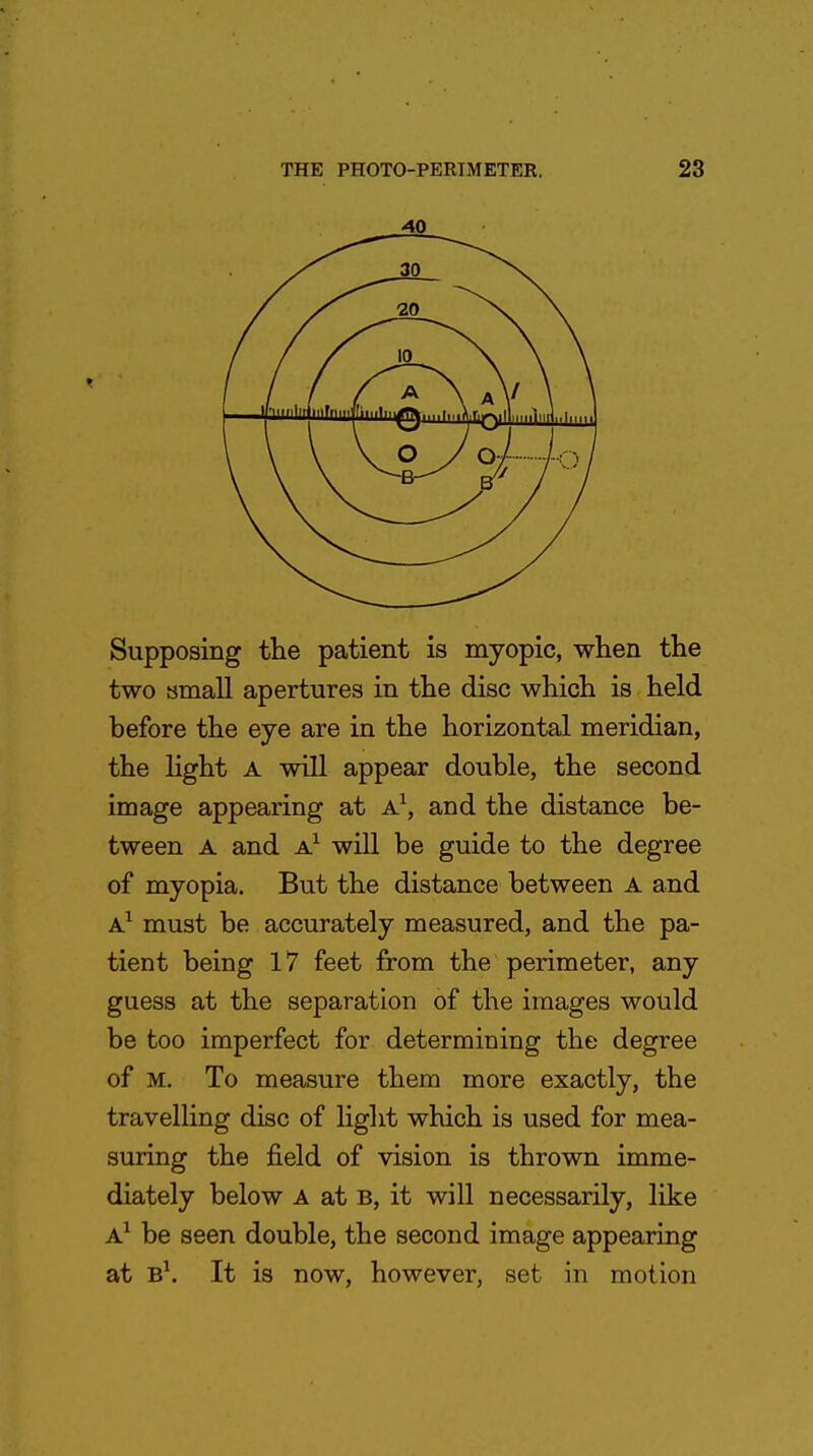 Supposing the patient is myopic, when the two small apertures in the disc which is held before the eye are in the horizontal meridian, the light A will appear double, the second image appearing at A1, and the distance be- tween A and a1 will be guide to the degree of myopia. But the distance between A and a1 must be accurately measured, and the pa- tient being 17 feet from the perimeter, any guess at the separation of the images would be too imperfect for determining the degree of M. To measure them more exactly, the travelling disc of light which is used for mea- suring the field of vision is thrown imme- diately below A at b, it will necessarily, like A1 be seen double, the second image appearing at B1. It is now, however, set in motion