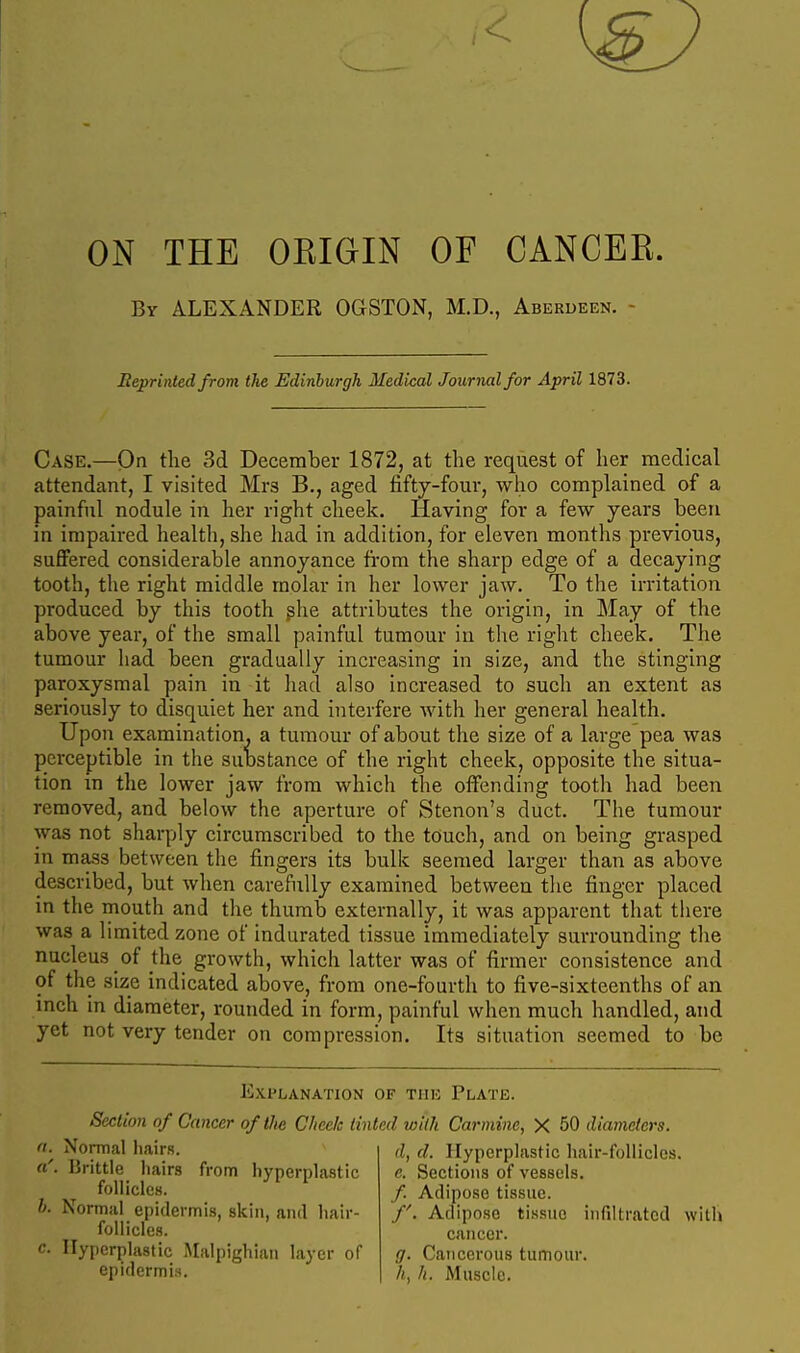 ON THE OEIGIN OF CANCER. By ALEXANDER OGSTON, M.D., Aberdeen. - Reprinted from the Edinburgh Medical Journal for April 1873. Case.—On the 3d December 1872, at the request of her medical attendant, I visited Mrs B., aged fifty-four, who complained of a painful nodule in her right cheek. Having for a few years been in impaired health, she liad in addition, for eleven months previous, suflfered considerable annoyance from the sharp edge of a decaying tooth, the right middle molar in her lower jaw. To the irritation produced by this tooth ghe attributes the origin, in May of the above year, of the small painful tumour in the right cheek. The tumour liad been gradually increasing in size, and the stinging paroxysmal pain in it had also increased to such an extent as seriously to disquiet her and interfere with her general health. Upon examination, a tumour of about the size of a large pea was perceptible in the substance of the right cheek, opposite the situa- tion in the lower jaw from which the offending tooth had been removed, and below the aperture of Stenon's duct. The tumour was not sharply circumscribed to the touch, and on being grasped in mass between the fingers its bulk seemed larger than as above described, but when carefully examined between the finger placed in the mouth and the thumb externally, it was apparent that there was a limited zone of indurated tissue immediately surrounding tlie nucleus of the growth, which latter was of firmer consistence and of the size indicated above, from one-fourth to five-sixteenths of an mch in diameter, rounded in form, painful when much handled, and yet not very tender on compression. Its situation seemed to be Explanation of the Plate. Section of Cancer of the Cheek tinted with Carmine, X 50 diameters. n. Normal hairs. a'. Brittle hairs from hyperplastic follicles. h. Normal epidermis, skin, and hair- follicles. c. Hyperplastic Malpighian layer of epidermis. d, d. Hyperplastic hair-follicles. c. Sections of vessels. /. Adipose tissue. /'. Adipose tissue infiltrated with cancer. g. Cancerous tumour. h, h. Muscle.