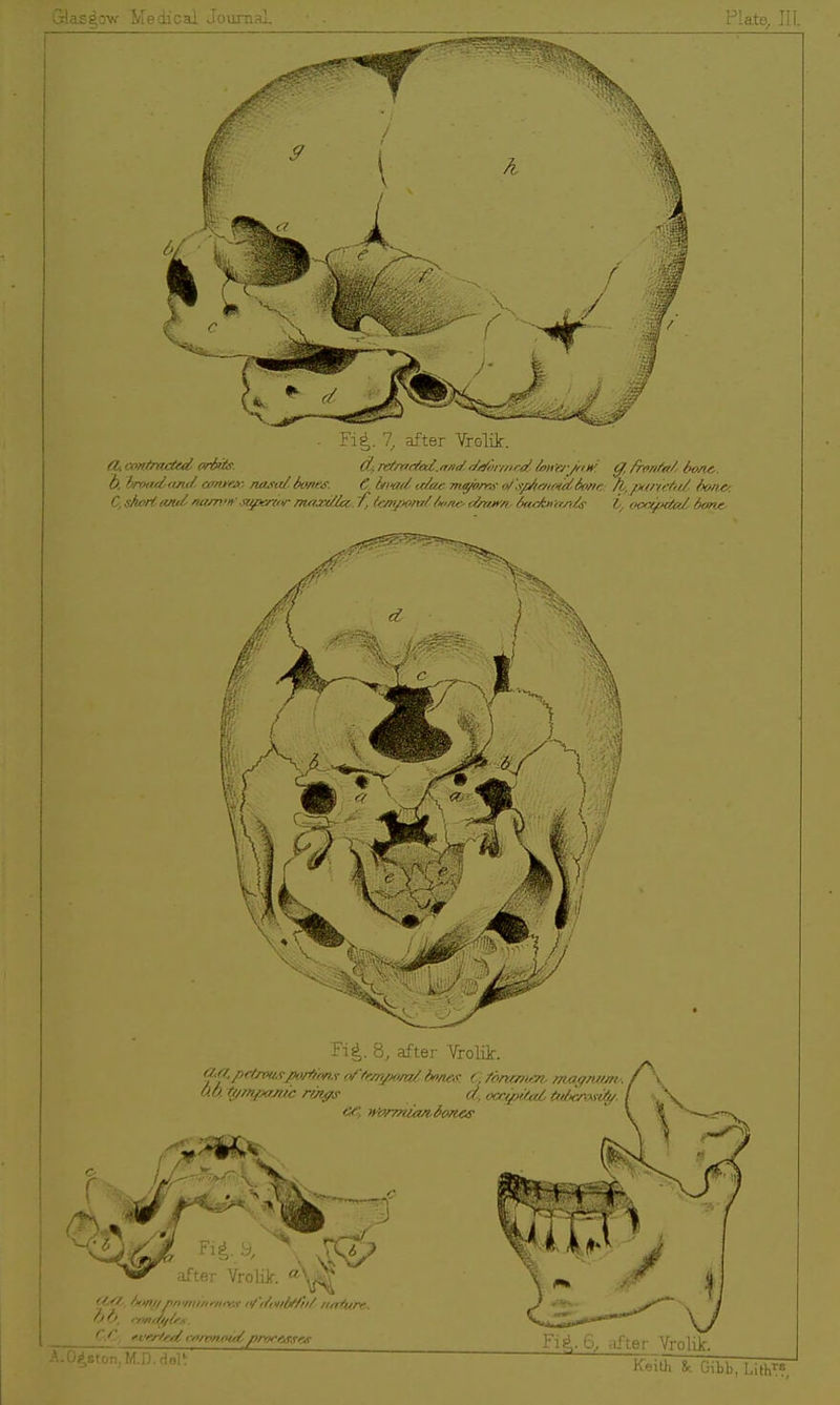 Glasgow Medical Journal Plata Jli . Fi|,. 7, after Vrolik. (I, contracted arl«6f. oL ret/rrrted.rr/id M)ii/'j-d /aiirj /i-iH'. g, /rontat, bon^. h, iroadnnd amm: nasidioneg. C hi-ad tdae m^omy o/'s/dir-jtftdSoni:: fl,pi)ri(fid fio/ic. C,sheHimd narn'n'st^ieriir in/7xMa,. 'f, /.t:mj>o/nttune- c//rr.»'/i 6cf/>iii>r^/!s- t, f,cr/^>{/a/. 6or>^ Fi^. 8, after Vrolik. Cua^peOvusjio/tfons o/'trmj»/id dnnex. ( /onaiim, moffnum^. an tz/mflcM/c rihffs d, <xctpi/a6 tuSerosiA/. after Vrolilf. h ^, fnndj/tf\. ?»,ston,M.D.HolV F]#,. 6, after VrolOc.