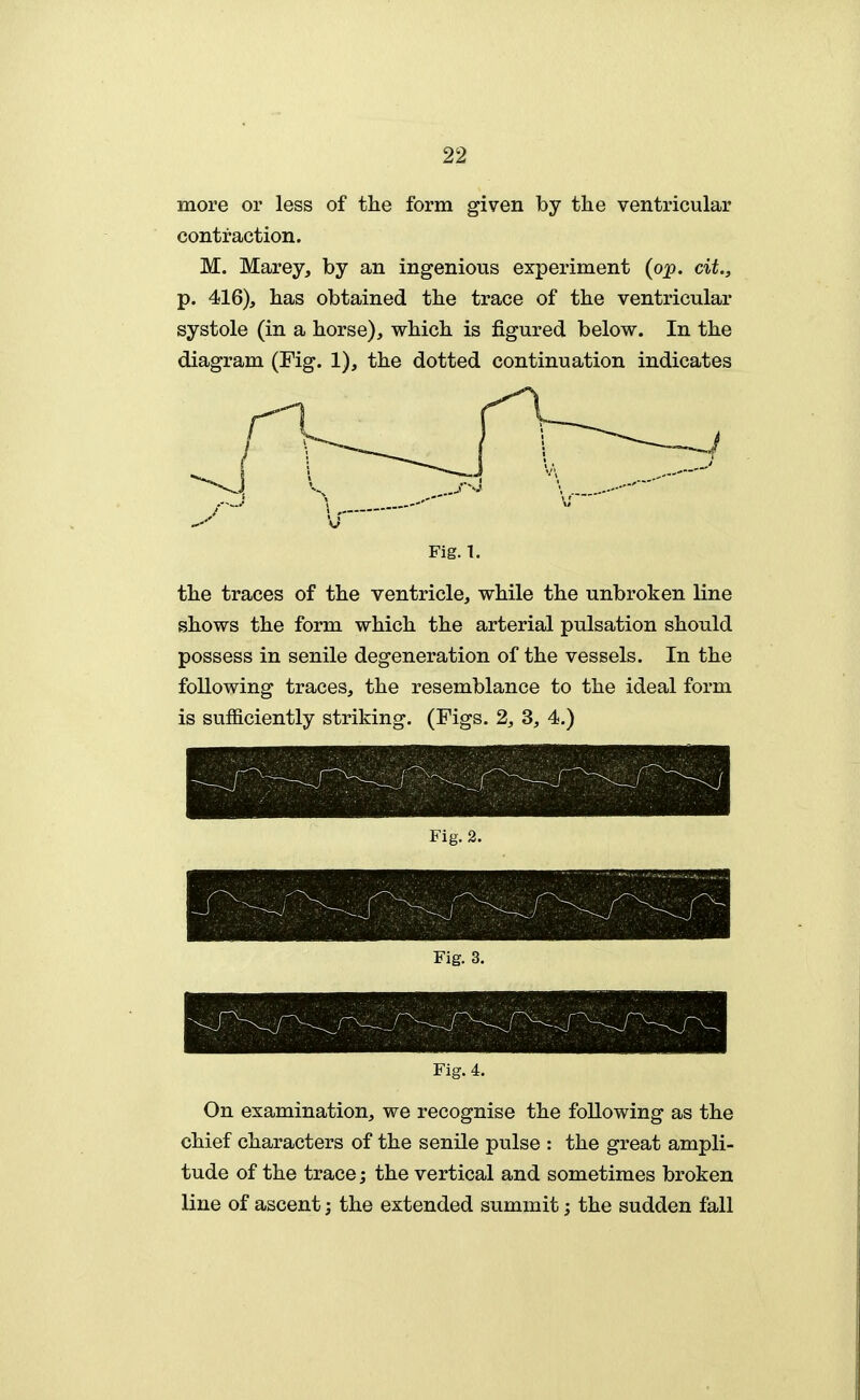 more or less of the form given by tlie ventricular contraction. M. Marey, by an ingenious experiment (op. cit., p. 416), has obtained the trace of the ventricular systole (in a horse), which is figured below. In the diagram (Fig. 1), the dotted continuation indicates Fig. 1. the traces of the ventricle, while the unbroken line shows the form which the arterial pulsation should possess in senile degeneration of the vessels. In the following traces, the resemblance to the ideal form is sufficiently striking. (Figs. 2, 3, 4.) Fig. 2. Fig. 4. On examination, we recognise the following as the chief characters of the senile pulse : the great ampli- tude of the trace; the vertical and sometimes broken line of ascent; the extended summit; the sudden fall