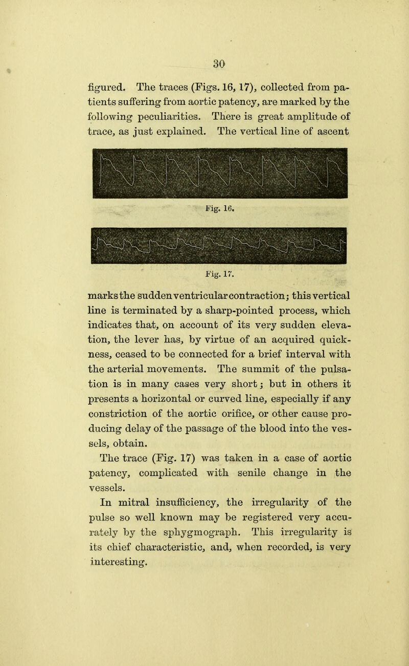 figured. The traces (Figs. 16,17), collected from pa- tients suffering from aortic patency, are marked by the following peculiarities. There is great amplitude of trace, as just explained. The vertical line of ascent Fig. 16. Fig. 17. marks the sudden ventricular contraction; this vertical line is terminated by a sharp-pointed process, which indicates that, on account of its very sudden eleva- tion, the lever has, by virtue of an acquired quick- ness, ceased to be connected for a brief interval with the arterial movements. The summit of the pulsa- tion is in many cases very short; but in others it presents a horizontal or curved line, especially if any constriction of the aortic orifice, or other cause pro- ducing delay of the passage of the blood into the ves- sels, obtain. The trace (Fig. 17) was taken in a case of aortic patency, complicated with senile change in the vessels. In mitral insufiiciency, the irregularity of the pulse so well known may be registered very accu- rately by the sphygmograph. This irregularity is its chief characteristic, and, when recorded, is very interesting.