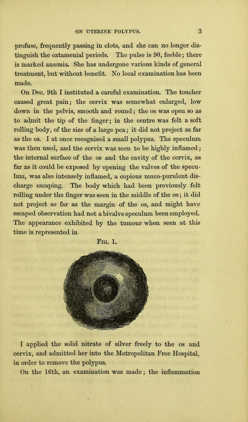 profuse, frequently passing in clots, and she can no longer dis- tinguish the catamenial periods. The pulse is 90, feeble; there is marked anaemia. She has undergone various kinds of general treatment, but without benefit. No local examination has been made. On Dec. 9th I instituted a careful examination. The toucher caused great pain; the cervix was somewhat enlarged, low down in the pelvis, smooth and round; the os was open so as to admit the tip of the finger; in the centre Was felt a soft rolling body, of the size of a large pea; it did not project as far as the OS. I at once recognised a small polypus. The speculum was then used, and the cervix was seen to be highly inflamed j the internal surface of the os and the cavity of the cervix, as far as it could be exposed by opening the valves of the specu- lum, was also intensely inflamed, a copious muco-purulent dis- charge escaping. The body which had been previously felt rolling under the finger was seen in the middle of the os; it did not project so far as the margin of the os, and might have escaped observation had not a bivalve speculum been employed. The appearance exhibited by the tumour when seen at this time is represented in EiG. 1. I applied the solid nitrate of silver freely to the os and cervix, and admitted her into the Metropolitan Free Hospital, in order to remove the polypus. On the 16th, an examination was made; the inflammation