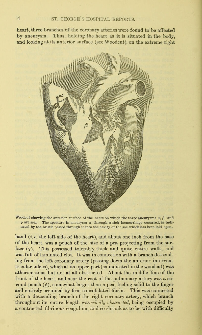 heart, three branches of the coronary arteries were found to be affected by aneurysm. Thus, holding the heart as it is situated in the body, and looking at its anterior surface (see Woodcut), on the extreme right Woodcut showing the anterior surface of the heart on which the three aneurysms «, /3, and y are seen. The aperture in aneurysm m, through which hasmorrhage occiured, is indi- cated by the bristle passed through it into the cavity of the sac which has been laid open. hand (^. e. the left side of the heart), and about one inch from the base of the heart, was a pouch of the size of a pea projecting from the sur- face (7). This possessed tolerably thick and quite entire walls, and was full of laminated clot. It was in connection with a branch descend- ing from the left coronary artery (passing down the anterior interven- tricular sulcus), which at its upper part (as indicated in the woodcut) was atheromatous, but not at all obstructed. About the middle line of the front of the heart, and near the root of the pulmonary artery was a se- cond pouch ()8), somewhat larger than a pea, feeling solid to the finger and entirely occupied by firm consolidated fibrin. This was connected with a descending branch of the right coronary artery, which branch throughout its entire length was ivliolly ohstructed, being occupied by a contracted fibrinous coagulum, and so shrunk as to be with difficulty