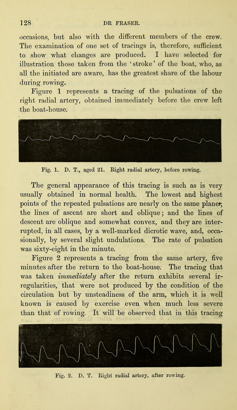 occasions, but also with the different members of the crew. The examination of one set of tracings is, therefore, sufficient to show what changes are produced. I have selected for illustration those taken from the ' stroke' of the boat, who, as all the initiated are aware, has the greatest share of the labour during rowing. Figure 1 represents a tracing of the pulsations of the right radial artery, obtained immediately before the crew left the boat-house. Fig. 1. D. T., aged 21. Eight radial artery, before rowing. The general appearance of this tracing is such as is very usually obtained in normal health. The lowest and highest points of the repeated pulsations are nearly on the same plane*; the lines of ascent are short and oblique; and the lines of descent are oblique and somewhat convex, and they are inter- rupted, in all cases, by a well-marked dicrotic wave, and, occa- sionally, by several slight undulations. The rate of pulsation was sixty-eight in the minute. Figure 2 represents a tracing from the same artery, five minutes after the return to the boat-house. The tracing that was taken immediately after the return exhibits several ir- regularities, that were not produced by the condition of the circulation but by unsteadiness of the arm, which it is well known is caused by exercise even when much less severe than that of rowing. It will be observed that in this tracing Fig. 2. D. T. Eight radial artery, after row-ing.