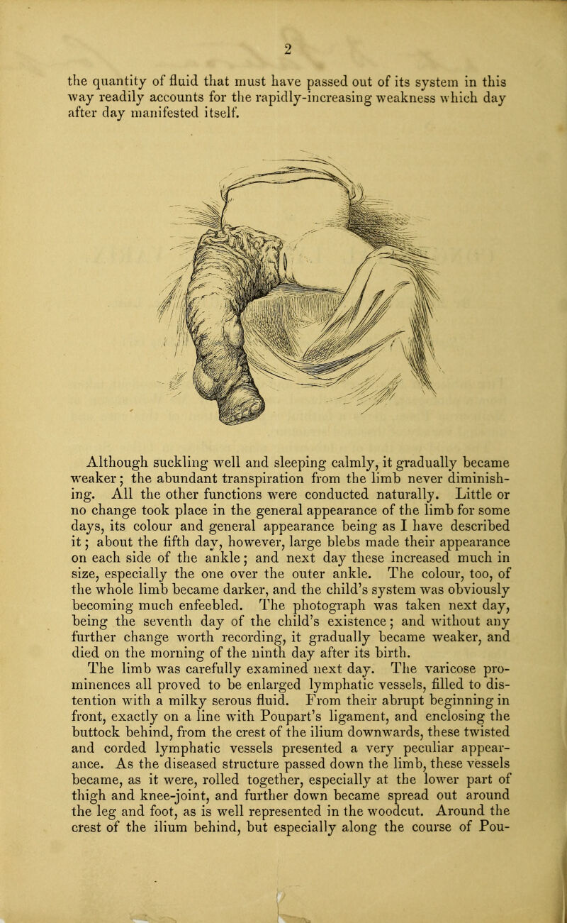 the quantity of flaid that must have passed out of its system in this way readily accounts for the rapidly-increasing weakness which day after day manifested itself. Although suckling well and sleeping calmly, it gradually became weaker; the abundant transpiration from the limb never diminish- ing. All the other functions were conducted naturally. Little or no change took place in the general appearance of the limb for some days, its colour and general appearance being as I have described it; about the fifth day, however, large blebs made their appearance on each side of the ankle; and next day these increased much in size, especially the one over the outer ankle. The colour, too, of the whole limb became darker, and the child's system was obviously becoming much enfeebled. The photograph was taken next day, being the seventh day of the child's existence; and without any further change Avorth recording, it gradually became weaker, and died on the morning of the ninth day after its birth. The limb was carefully examined next day. The varicose pro- minences all proved to be enlarged lymphatic vessels, filled to dis- tention with a milky serous fluid. From their abrupt beginning in front, exactly on a line with Poupart's ligament, and enclosing the buttock behind, from the crest of the ilium downwards, these twisted and corded lymphatic vessels presented a very peculiar appear- ance. As the diseased structure passed down the limb, these vessels became, as it were, rolled together, especially at the lower part of thigh and knee-joint, and further down became spread out around the leg and foot, as is well represented in the woodcut. Around the crest of the ilium behind, but especially along the course of Pou-