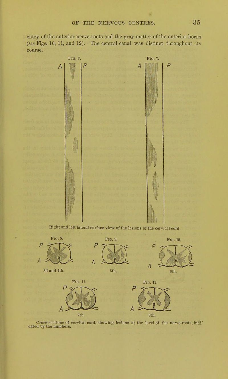 4' OP THE NEEVOtrS CENTEES. 35 entry of the anterior nerve-roots and the gray matter of the anterior horns (see Figs. 10, 11, and 12). The central canal was distinct throughout its course. Fig. C. Fig. 7. A If i I ■ 11' Right and left lateral enrface view of the IcbIodb of the cervical cord. I 11 Fig.'8. Fig. 9. Fig. 10. 3d and 4tb. 5tli. Cth. Fig. 11. Fia. 12. 8th. CroBB-sectiong of cervical cord, showing lesions at the level of the norve-roots, Indi catcd by the numbers.
