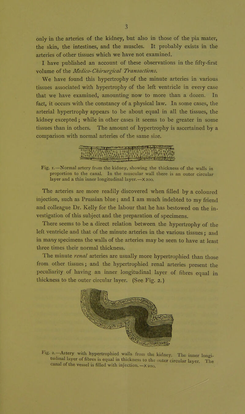 only in the arteries of the kidney, but also in those of the pia mater, the skin, the intestines, and the muscles. It probably exists in the arteries of other tissues which we have not examined. I have published an account of these observations in the fifty-first volume of the Medico-Chirurgical Tra7tsactions. We have found this hypertrophy of the minute arteries in various tissues associated with hypertrophy of the left ventricle in every case that we have examined, amounting now to more than a dozen. In fact, it occurs with the constancy of a physical law. In some cases, tlie arterial hypertrophy appears to be about equal in all the tissues, the kidney excepted; while in other cases it seems to be greater in some tissues than in others. The amount of hypertrophy is ascertained by a comparison with normal arteries of the same size. Fig. I.—Normal artery from the kidney, showing the thickness of the walls in proportion to the canal. In the muscular wall there is an outer circular layer and a thin inner longitudinal layer.—X200. The arteries are more readily discovered when filled by a coloured injection, such as Prussian blue ; and I am much indebted to my friend and colleague Dr. Kelly for the labour that he has bestowed on the in- vestigation of this subject and the preparation of specimens. There seems to be a direct relation between the hypertrophy of the left ventricle and that of the minute arteries in the various tissues; and in many specimens the walls of the arteries may be seen to have at least three times their normal thickness. The minute renal arteries are usually more hypertrophied than those from other tissues; and the hypertrophied renal arteries present the peculiarity of having an inner longitudinal layer of fibres equal in thickness to the outer circular layer. (See Fig. 2.) l''ig. 2.-Artery with hypertrophied walls from the kidney. The inner longi- tudnial layer of fibres is equal in thickness lo the outer circular layer. The canal of the vessel is filled with injection.—X 200.