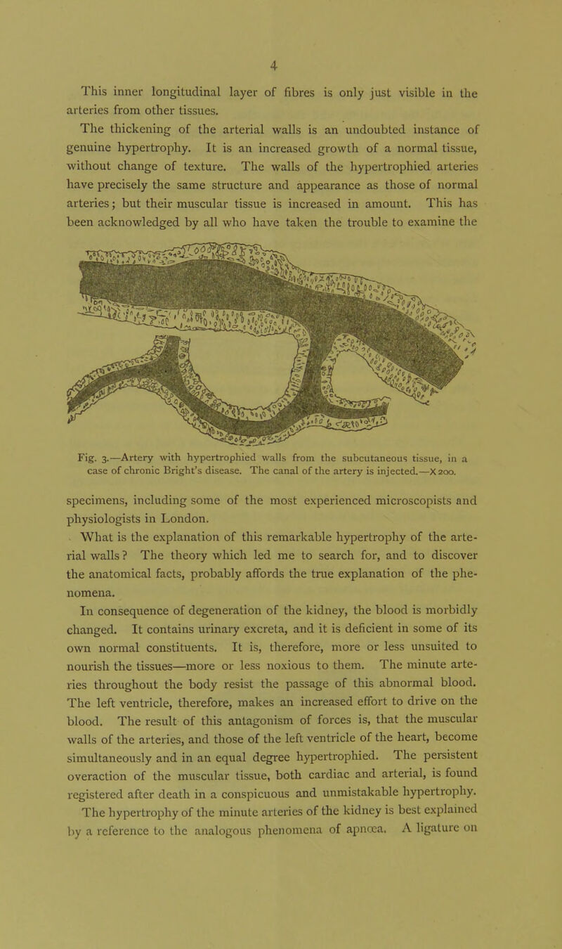 This inner longitudinal layer of fibres is only just visible in the arteries from other tissues. The thickening of the arterial walls is an undoubted instance of genuine h)rpertropliy. It is an increased growth of a normal tissue, without change of texture. The walls of the hypertrophied arteries have precisely the same structure and appearance as those of normal arteries; but their muscular tissue is increased in amount. This has been acknowledged by all who have taken the trouble to examine the Fig. 3.—Artery with hypertrophied walls from the subcutaneous tissue, in a case of chronic Bright's disease. The canal of the artery is injected.—X200. specimens, including some of the most experienced microscopists and physiologists in London. What is the explanation of this remarkable hypertrophy of the arte- rial walls ? The theory which led me to search for, and to discover the anatomical facts, probably affords the true explanation of the phe- nomena. In consequence of degeneration of the kidney, the blood is morbidly changed. It contains urinaiy excreta, and it is deficient in some of its own normal constituents. It is, therefore, more or less unsuited to nourish the tissues—^more or less noxious to them. The minute arte- ries throughout the body resist the passage of this abnormal blood. The left ventricle, therefore, makes an increased effort to drive on the blood. The result of this antagonism of forces is, that the muscular walls of the arteries, and those of the left ventricle of the heart, become simultaneously and in an equal degree hypertrophied. The persistent overaction of the muscular tissue, both cardiac and arterial, is found registered after death in a conspicuous and unmistakable hypertrophy. The hypertrophy of the minute arteries of the kidney is best explained by a reference to the analogous phenomena of apncea. A ligature on