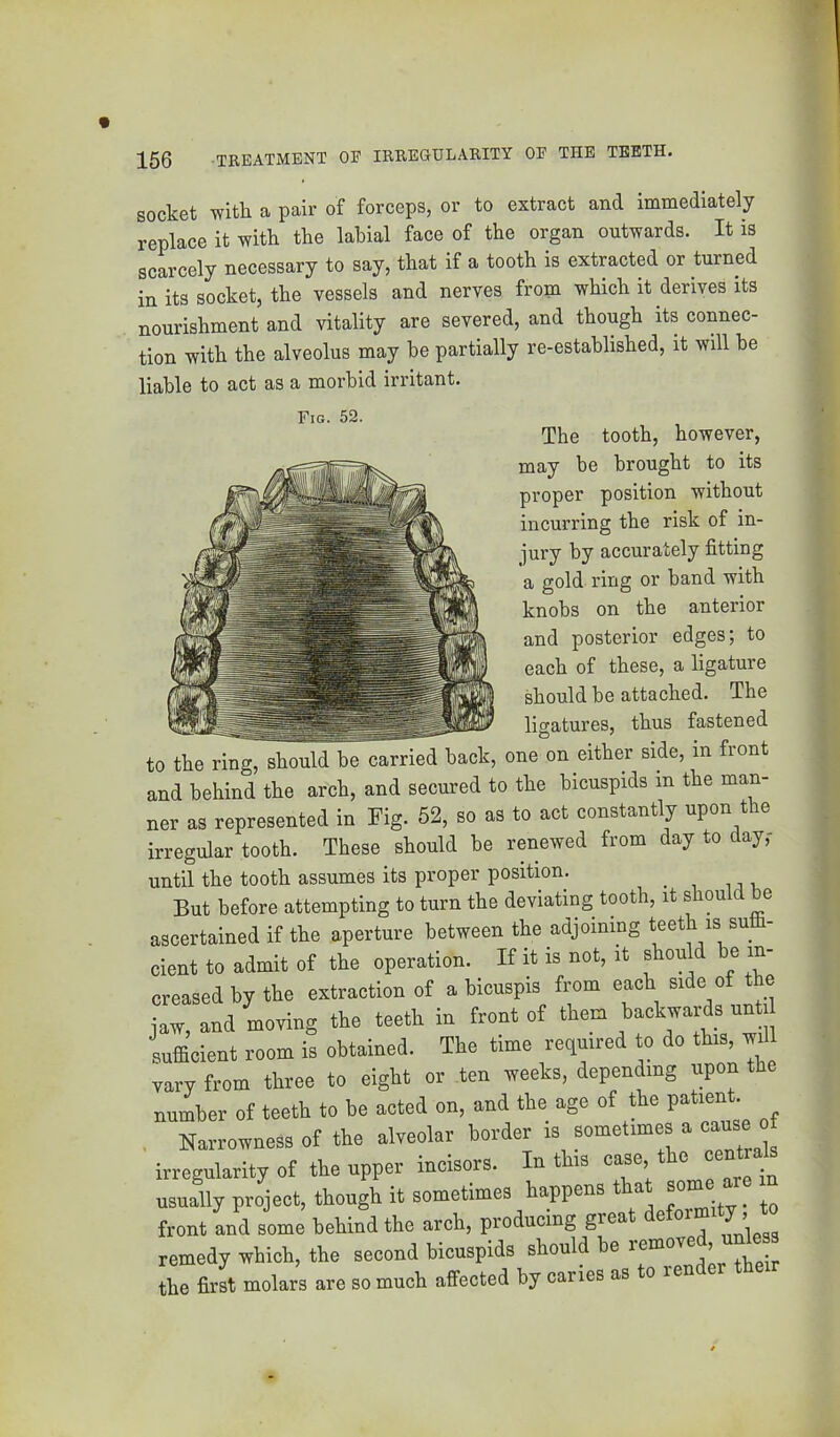 socket with a pair of forceps, or to extract and immediately replace it with the labial face of the organ outwards. It is scLcely necessary to say, that if a tooth is extracted or turned in its socket, the vessels and nerves from which it derives its nourishment and vitality are severed, and though its connec- tion with the alveolus may be partially re-established, it will be liable to act as a morbid irritant. Fig. 52. The tooth, however, may be brought to its proper position without incurring the risk of in- jury by accurately fitting a gold ring or band with knobs on the anterior and posterior edges; to each of these, a ligature should be attached. The ——ligatures, thus fastened to the ring, should be carried back, one on either side, in front and behind the arch, and secured to the bicuspids in the man- ner as represented in Fig. 52, so as to act constantly upon the irregular tooth. These should be renewed from day to day,- until the tooth assumes its proper position. ^ But before attempting to turn the deviating tooth, it shou e aaoertained it the aperture between the adjoining teeth is sutt- cient to admit of the operation. It it is not. it should be in- creased by the extraction of a bicnspis from each side ot the jaw, and moving the teeth in front ot them ^okwa ds nnt sufficient room is obtained. The time reoiuired to do this, will vary from three to eight or ten weeks, depending upon the number ot teeth to be acted on, and the age ot the patient. , NLowneSs of the alveolar border is sometimes a cause irregularity ot the upper incisors. In this case, the centrids usually project, though it sometimes happens that “m front and some behind the arch, producing great J ’ remedy which, the second bicuspids should be , ■ tbe first molars are so much affected by caries as o le