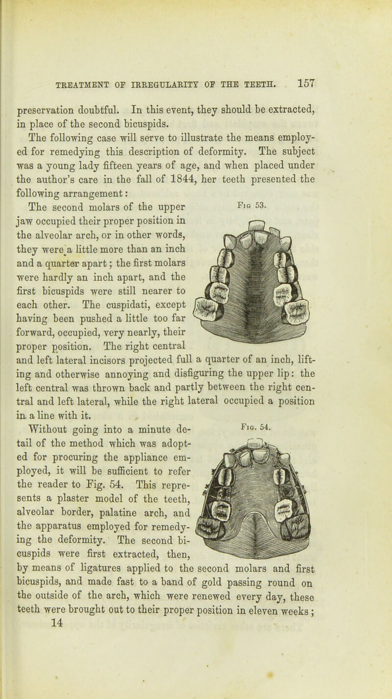 preservation doubtful. In tbis event, they should be extracted, in place of the second bicuspids. The following case will serve to illustrate the means employ- ed for remedying this description of deformity. The subject was a young lady fifteen years of age, and when placed under the author’s care in the fall of 1844, her teeth presented the following arrangement: The second molars of the upper jaw occupied their proper position in the alveolar arch, or in other words, they were^^a little more than an inch and a quarter apart; the first molars were hardly an inch apart, and the first bicuspids were still nearer to each other. The cuspidati, except having been pushed a little too far forward, occupied, very nearly, their proper position. The right central and left lateral incisors projected full a quarter of an inch, lift- ing and otherwise annoying and disfiguring the upper lip: the left central was thrown back and partly between the right cen- tral and left lateral, while the right lateral occupied a position in. a line with it. Without going into a minute de- tail of the method which was adopt- ed for procuring the appliance em- ployed, it will be sufiicient to refer the reader to Fig. 54. This repre- sents a plaster model of the teeth, alveolar border, palatine arch, and the apparatus employed for remedy- ing the deformity. The second bi- cuspids were first extracted, then, by means of ligatures applied to the second molars and first bicuspids, and made fast to a band of gold passing round on the outside of the arch, which were renewed every day, these teeth were brought out to their proper position in eleven weeks; 14 Fio 53.