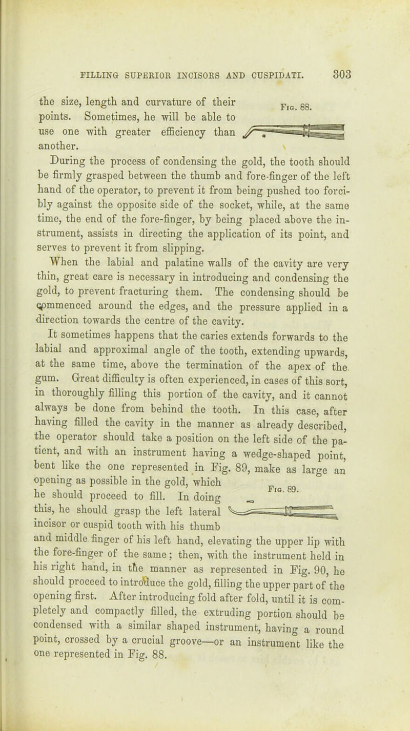 the size, length and curvature of their gg points. Sometimes, he will be able to use one with greater efficiency than another. During the process of condensing the gold, the tooth should be firmly grasped between the thumb and fore-finger of the left hand of the operator, to prevent it from being pushed too forci- bly against the opposite side of the socket, while, at the same time, the end of the fore-finger, by being placed above the in- strument, assists in directing the application of its point, and serves to prevent it from slipping. When the labial and palatine walls of the cavity are very thin, great care is necessai'y in introducing and condensing the gold, to prevent fracturing them. The condensing should be opmmenced around the edges, and the pressure applied in a direction towards the centre of the cavity. It sometimes happens that the caries extends forwards to the labial and approximal angle of the tooth, extending upwards, at the same time, above the termination of the apex of the gum. Great difficulty is often experienced, in cases of this sort, in thoroughly filling this portion of the cavity, and it cannot always be done from behind the tooth. In this case, after having filled the cavity in the manner as already described, the operator should take a position on the left side of the pa- tient, and with an instrument having a wedge-shaped point, bent like the one represented in Fig. 89, make as large an opening as possible in the gold, which he should proceed to fill. In doing this, he should grasp the left lateral incisor or cuspid tooth with his thumb and middle finger of his left hand, elevating the upper lip with the fore-finger of the same; then, with the instrument held in his right hand, in the manner as represented in Fig. 90, he should proceed to introVluce the gold, filling the upper part of the opening first. After introducing fold after fold, until it is com- pletely and compactly filled, the extruding portion should be condensed with a similar shaped instrument, having a round point, crossed by a crucial groove—or an instrument like the one represented in Fig. 88. I