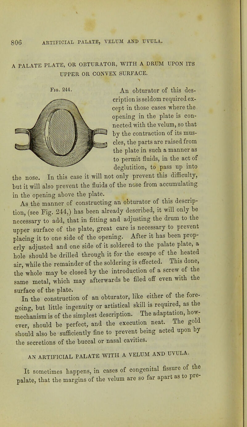 A PALATE PLATE, OR OBTURATOR, WITH A DRUM UPON ITS UPPER OR CONVEX SURFACE. cription is seldom required ex- cept in those cases where the opening in the plate is con- by the contraction of its mus- cles, the parts are raised from the plate in such a manner as to permit fluids, in the act of deglutition, to pass up into the nose. In this case it will not only prevent this diflBculty, but it will also prevent the fluids of the nose from accumulating in the opening above the plate. As the manner of constructing an obturator of this descrip- tion, (see Fig. 244,) has been already described, it will only be necessary to add, that in fitting and adjusting the drum to the upper surface of the plate, great care is necessary to prevent placing it to one side of the opening. After it has been prop- erly adjusted and one side of it soldered to the palate plate, a hole should be drilled through it for the escape of the heated air, while the remainder of the soldering is effected. This done, the whole may be closed by the introduction of a screw of the same metal, which may afterwards be filed off even with the surface of the plate. ^ n r j? In the construction of an obturator, like either of the fore- going, but little ingenuity or artistical skill is required, as the mechanism is of the simplest description. The adaptation, how- ever, should be perfect, and the execution neat. The gold should also be sufficiently fine to prevent being acted upon by the secretions of the huccal or nasal cavities. AN ARTIFICIAL PALATE WITH A VELUM AND UVULA. It sometimes happens, in cases of congenital fissure of th palate, that the margins of the velum are so far apart as to p