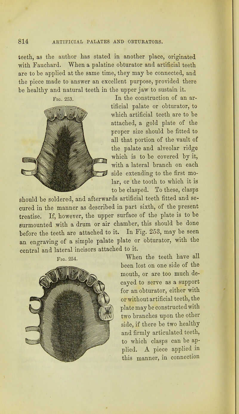 teeth, as the author has stated in another place, originated with Fauchard. When a palatine obturator and artificial teeth are to be applied at the same time, they may be connected, and the piece made to answer an excellent purpose, provided there be healthy and natural teeth in the upper jaw to sustain it. Fig. 253. Id the construction of an ar- tificial palate or obturator, to which artificial teeth are to be attached, a gold plate of the proper size should be fitted to all that portion of the vault of the palate and alveolar ridge which is to be covered by it, with a lateral branch on each side extending to the first mo- lar, or the tooth to which it is to be clasped. To these, clasps should be soldered, and afterwards artificial teeth fitted and se- cured in the manner as described in part sixth, of the present treatise. If, however, the upper surface of the plate is to be surmounted with a drum or air chamber, this should be done before the teeth are attached to it. In Fig. 253, may be seen an engraving of a simple palate plate or obturator, with the central and lateral incisors attached to it. When the teeth have all been lost on one side of the mouth, or are too much de- cayed to serve as a support for an obturator, either with or without artificial teeth, the plate may be constructed with two branches upon the other side, if there be two healthy and firmly articulated teeth, to which clasps can be ap- plied. A piece applied in this manner, in connection