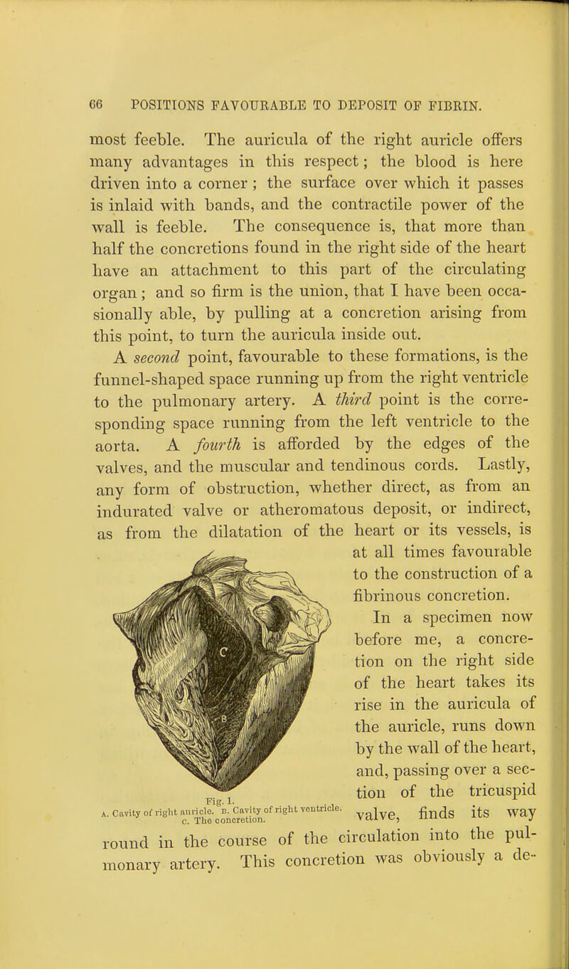 most feeble. The auricula of the right auricle offers many advantages in this respect; the blood is here driven into a corner; the surface over which it passes is inlaid with bands, and the contractile power of the wall is feeble. The consequence is, that more than half the concretions found in the right side of the heart have an attachment to this part of the circulating organ; and so firm is the union, that I have been occa- sionally able, by pulling at a concretion arising from this point, to turn the auricula inside out. A second point, favourable to these formations, is the funnel-shaped space running up from the right ventricle to the pulmonary artery. A third point is the corre- sponding space running from the left ventricle to the aorta. A fourth is afforded by the edges of the valves, and the muscular and tendinous cords. Lastly, any form of obstruction, whether direct, as from an indurated valve or atheromatous deposit, or indirect, as from the dilatation of the heart or its vessels, is at all times favourable to the construction of a fibrinous concretion. In a specimen now before me, a concre- tion on the right side of the heart takes its rise in the auricula of the auricle, runs down by the wall of the heart, and, passing over a sec- tion of the tricuspid valve, finds its way round in the course of the circulation into the pul- monary artery. This concretion was obviously a de- fig-1- A Cftvity of right auricle, b. Cavity of right ventricle, c. The concretion.