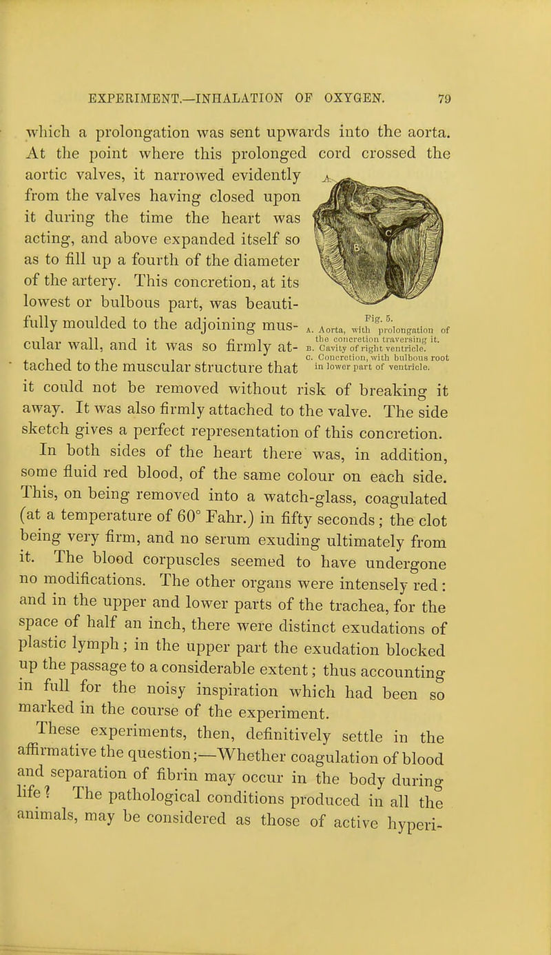 ■which a prolongation was sent upwards into the aorta. At the point where this prolonged cord crossed the aortic valves, it narrowed evidently from the valves having closed upon it during the time the heart was acting, and above expanded itself so as to fill up a fourth of the diameter of the artery. This concretion, at its lowest or bulbous part, was beauti- fully moulded to the adjoining mus- A. Aorta, ^%Lngam of „,,1„. „.„n . i n i , the concretion traversing it. cuiai wall, ana it was so firmly at- b. cavity 0f right ventricle. , j '1 , c. Concretion, with bulbous root tacnea to the muscular structure that in lowerpan of ventricle, it could not be removed without risk of breaking it away. It was also firmly attached to the valve. The side sketch gives a perfect representation of this concretion. In both sides of the heart there was, in addition, some fluid red blood, of the same colour on each side. This, on being removed into a watch-glass, coagulated (at a temperature of 60° Fahr.) in fifty seconds; the clot being very firm, and no serum exuding ultimately from it. The blood corpuscles seemed to have undergone no modifications. The other organs were intensely red: and in the upper and lower parts of the trachea, for the space of half an inch, there were distinct exudations of plastic lymph j in the upper part the exudation blocked up the passage to a considerable extent; thus accounting in full for the noisy inspiration which had been so marked in the course of the experiment. These experiments, then, definitively settle in the affirmative the question;—Whether coagulation of blood and separation of fibrin may occur in the body during life % The pathological conditions produced in all the annuals, may be considered as those of active hyperi-