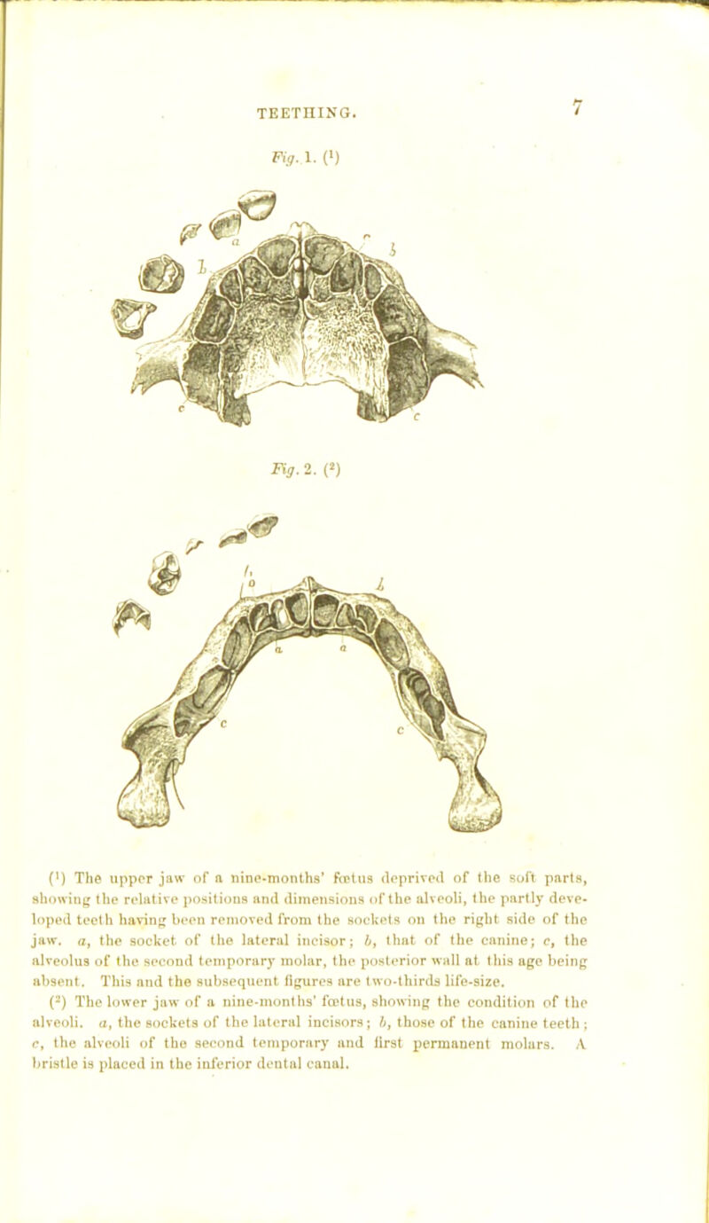 Fig. 1. (l) (') The upper jaw of a nine-months' Gostos deprived of the soft parts, showing the relative positions and dimensions of the alveoli, the partly deve- loped teeth having been removed from the sockets on the right side of the jaw. a, the socket of the lateral incisor; 4, that of the canine; c, the alveolus of the second temporary molar, the posterior wall at this age being absent. This and the subsequent figures are two-thirds life-size. (2) The lower jaw of a nine-months' foetus, showing the condition of the alveoli, a, the sockets of the lateral incisors; b, those of the canine teeth ; e, the alveoli of the second temporary and lirst permanent molars. \ bristle is placed in the inferior dental canal.