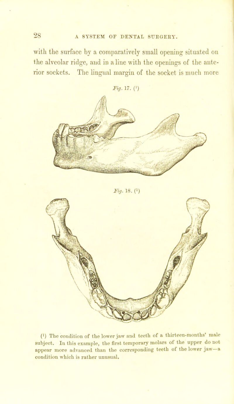 with the surface by a comparatively small opening situated on the alveolar ridge, and in aline with the openings of the ante- rior sockets. The lingual margin of the socket is much more Fig. 17. (') (') The condition of the lower jaw and teeth of a thirteeu-months' male subject. In this example, the first temporary molars of the upper do not appear more advanced than the corresponding teeth of the lower jaw—a condition which is rather unusual.