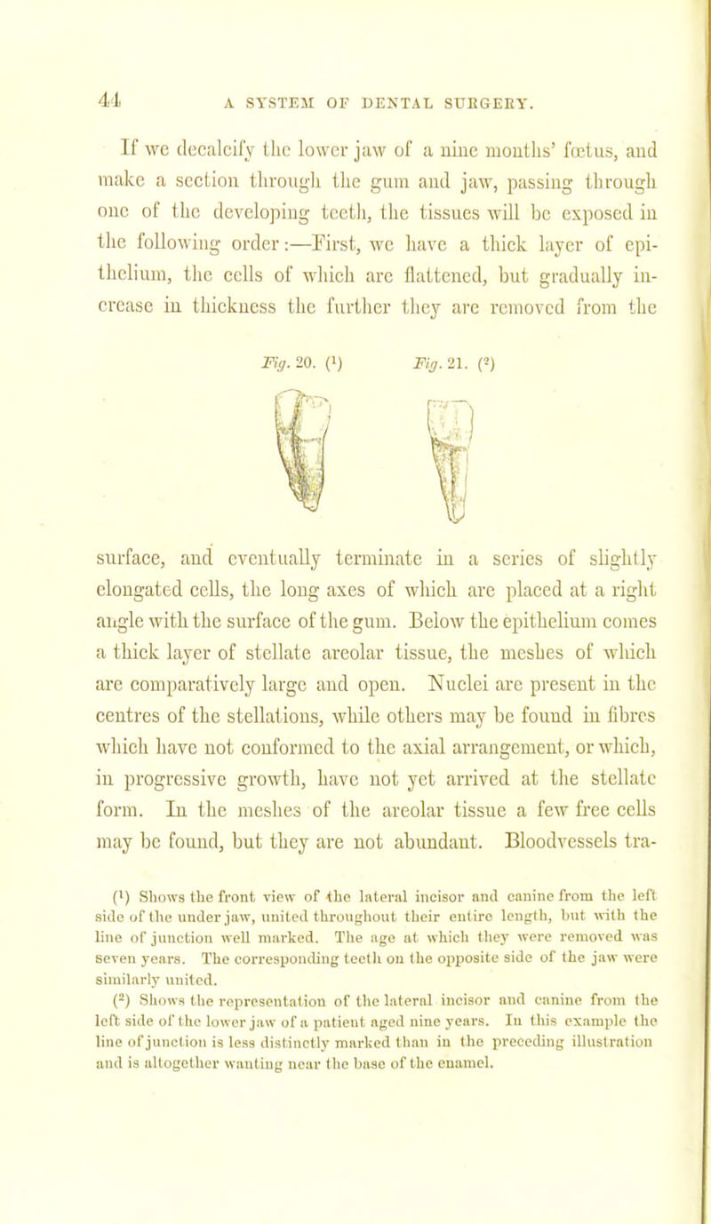 If wc decalcify the lower jaw of a nine mouths' foetus, and make a section through the gum and jaw, passing through one of the developing teeth, the tissues will be exposed iu the following order:—First, wc have a thick layer of epi- thelium, the cells of which arc flattened, but gradually in- crease in thickness the further they are removed from the Fig. 20. (i) Fig. 21. (*) surface, and eventually terminate in a series of slightly elongated cells, the long axes of which are placed at a right angle with the surface of the gum. Below the epithelium comes a thick layer of stellate areolar tissue, the meshes of which are comparatively large and open. Nuclei arc present in the centres of the stellafions, while others may be found in fibres which have not conformed to the axial arrangement , or which, in progressive growth, have not yet arrived at the stellate form. In the meshes of the areolar tissue a few free cells may be found, but they are not abundant. Bloodvessels tra- {') Shows the front view of the lateral incisor and canine from the left Bide of the under jaw, united throughout their entire length, but with the line of junction well marked. The age at which they were removed was seven years. The corresponding teeth on the opposite side of the jaw were similarly united. (2) Shows the representation of the lateral incisor and canine from the left side of the lower jaw of a patient aged nine years. In this example the line of junction is less distinctly marked than in the preceding illustration and is altogether wanting near the base of the enamel.