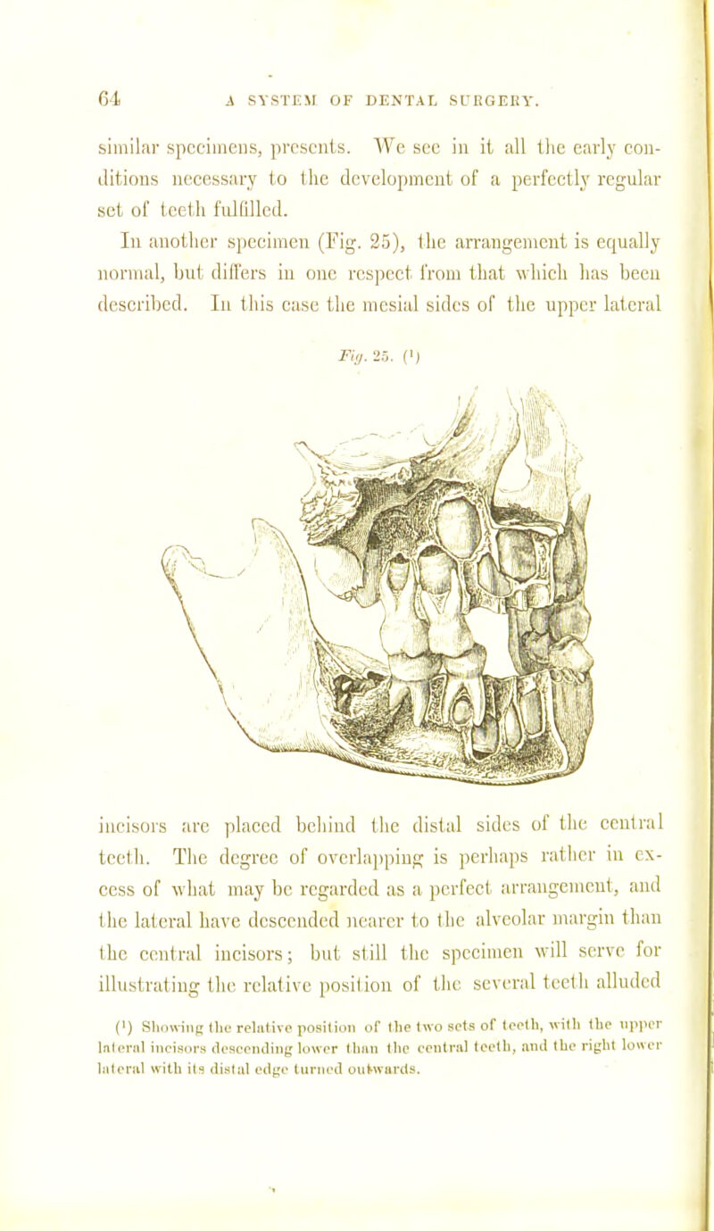 similar specimens, presents. We see in ii all the early con- ditions necessary to 1 lie development of a perfectly regular set of teeth fulfilled. In another specimen (Fig. 25), the arrangement is equally normal, but differs in one respect from that which has been described. In this case the mesial sides of the upper lateral Fi,,. 25. (') incisors are placed behind the distal sides of the central teeth. The degree of overlapping is perhaps rather in ex- cess of what may be regarded as a perfect, arrangement, and the lateral have descended nearer to the alveolar margin than the central incisors; but still the specimen will serve for illustrating the relative posilion of the several teeth alluded f1) Showing the relative position of the two sets of teeth, with the upper lnteral incisors descending lower than the contra] teeth, and the right lower lateral with its distal edge turned outwards.