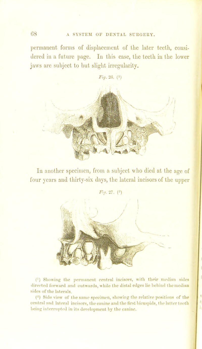 permanent forms of displacement of the later teeth, consi- dered in a future page. In this case, the teeth in the lower jaws arc subject to but slight irregularity. Fig. 20. (') In another specimen, from a subject who died at the age of four years and thirty-six days, the lateral incisors of the upper Fig. 27. (*) (') Showing the permanent central incisors, with their median sides directed forward and outwards, while tlie distal edges lie behind (liemedian sides of the laterals. (-) Side view of the same specimen, showing the relative positions of the oenl ral lind lateral incisors. II),■ canine and the lirst bicuspids, the latter tooth being interrupted in its development by the canine.