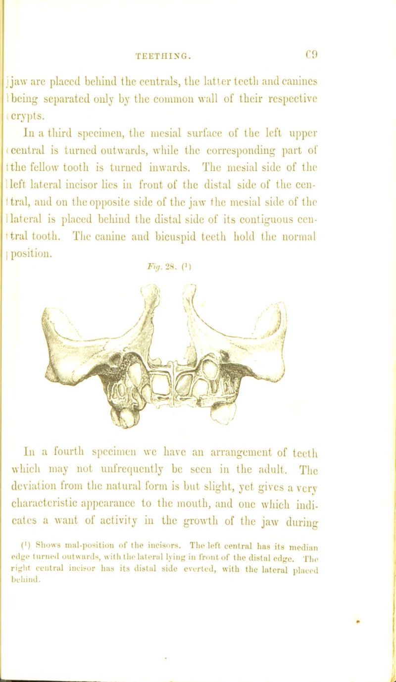 C9 jaw are placed belaud the centrals, the latter teeth and canines : being separated only by the common wall of their respective i crypts. Iu a third specimen, the mesial surface of the left upper central is turned outwards, while the corresponding part of i the fellow tooth is turned inwards. The mesial side of the ^ left lateral incisor lies in front of the distal side of the cen- Itral, and on the opposite side of the jaw the mesial side of the I lateral is placed behind the distal side of its contiguous cen- tral tooth. The canine and bicuspid teeth hold the normal | position. Fi:l. 28. (') In a fourth specimen we have an arrangement of teeth which may not unfrequently be seen in the adult. The deviation from the natural form is but slight, yet gives a very characteristic appearance to the mouth, and one which indi- cates a want of activity in the growth of the jaw during (') Show* null-position of the incisors. Thelefl centra] tins its median edge turned outwards, with the lateral lying in front of the distal e«Ve. The right central incisor has its distal side everted, with the lateral placed behind.