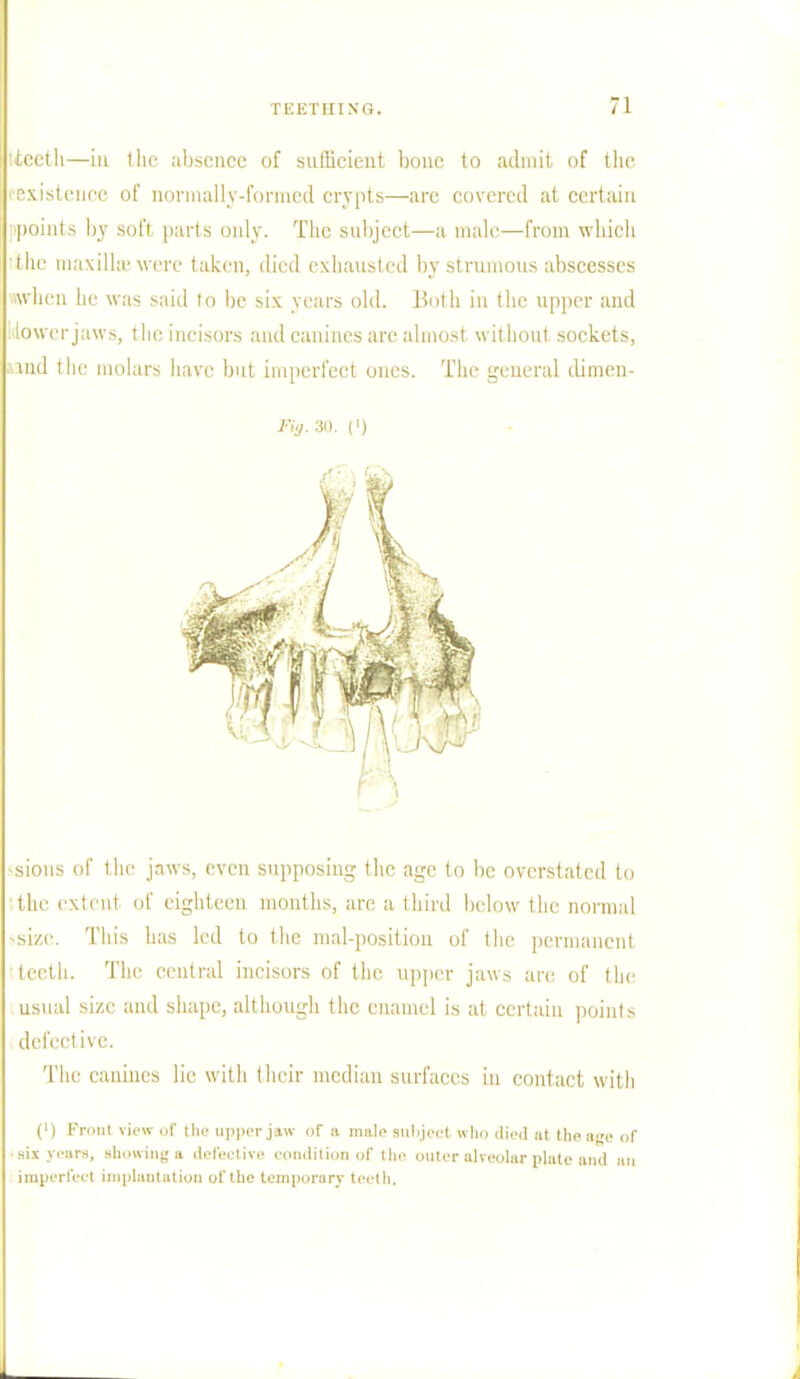 •teeth—in tltc absence of sufficient bone to admit of the ' existence of normally-formed crypts—are covered at certain points by soft parts only. The subject—a nude—from which the max ilia'were taken, died exhausted by strumous abscesses when he was said to be six years old. Both in the upper and slower jaws, the incisors and canines are almost without sockets, ■and the molars have but imperfect ones. The general dimen- Fig. 30. (i) •sions of the jaws, even supposing the age to be overstated to :the extent of eighteen months, are a third below the normal -size. This has led to the mal-position of the permanent teeth. The central incisors of the upper jaws are of the usual size and shape, although the enamel is at certain points defective. The canines lie with their median surfaces in contact with (') Front view of the upper jaw oT a male subject who died at the age of •six years, showing* defective condition of the outer alveolar plate and an imperfect implantation of the temporary teeth.