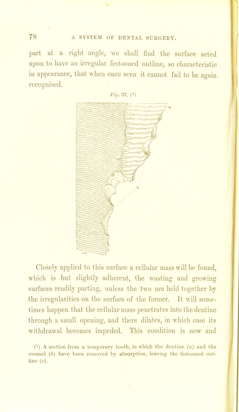 part at a right angle, we shall find the surface acted upon to have an irregular festooned outline, so characteristic in appearance, that when once seen it cannot fail to be again recognised. l-uj. 33. (I) Closely applied to this surface a cellular mass will be found, which is but slightly adherent, the wasting and growing surfaces readily parting, unless the two are held together by the irregularities on the surface of the former. It will some- limes happen that the cellular mass penetrates into the dentine through a small opening, and there dilates, in which case its withdrawal becomes impeded. This condition is now and (') A section from a temporary tooth, in which the dentine (h) imd the enamel (b) have been removed by absorption, leaving the festooned out- line (c).