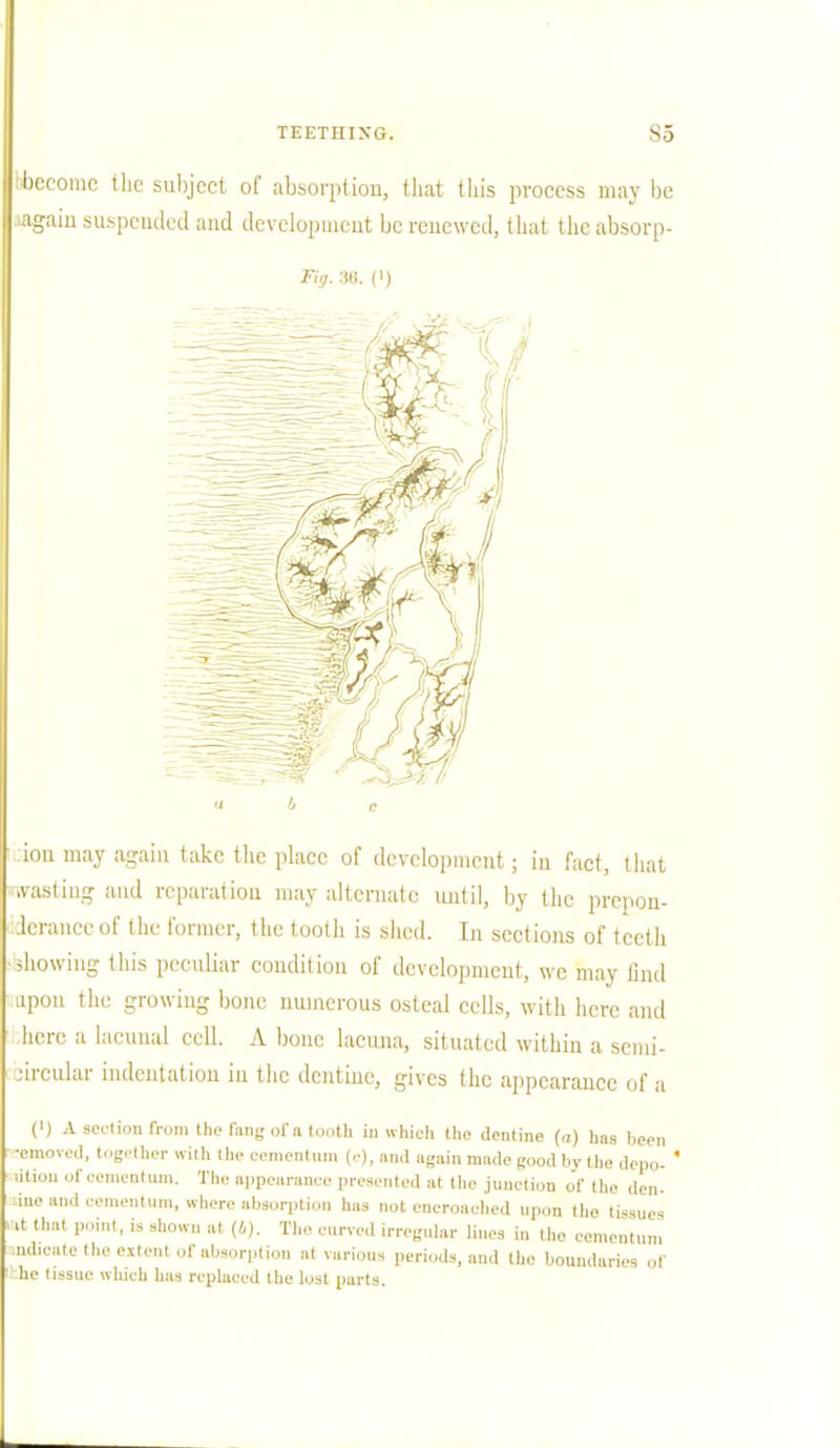 ibecomc the subject of absorption, that this process may be .again suspended and development be renewed, that the absorp- Fiv. 38. (') ;.:ion may again take the place of development; in fact, that .wasting and reparation may alternate until, by the prepon- derance of the former, the tooth is shed. In sections of teeth -showing this peculiar condition of development, we may find upon the growing bone numerous osteal cells, with here and here a lacuual cell. A bone lacuna, situated within a semi- circular indentation in the dentine, gives the appearance of a (') A section from the fang of a tooth in which the dentine (a) has been -emoved, together with the eementum (e), ami again made good by the depo- ' lition of eementum. The appearance presented at the junction of the den- ine and eementum, where absorption has not encroached upon the tissues it that point, is shown at (/,). The curve,! irregular lines in the eementum .udicate the extent of absorption at various periods, and the boundaries of :he tissue which has replaced the lost parts.