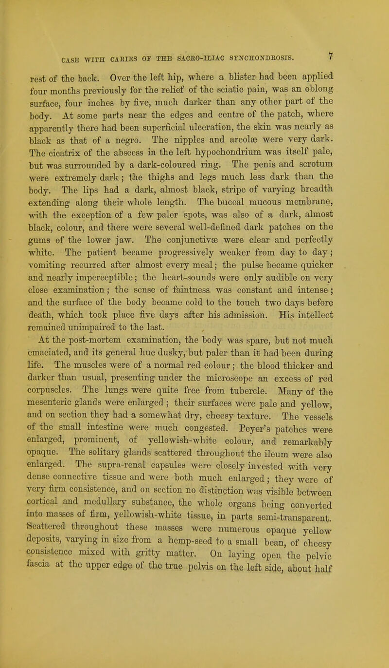 rest of the back. Over the left hip, where a blister had been applied four months previously for the relief of the sciatic pain, was an oblong sm-face, four inches by five, much darker than any other part of the body. At some parts near the edges and centre of the patch, where apparently there had been superficial ulceration, the skin was nearly as black as that of a negro. The nipples and areolae were very dark. The cicatrix of the abscess in the left hypochondrium was itself pale, but was surrounded by a dark-coloured ring. The penis and scrotum were exti-emely dark; the thighs and legs much less dark than the body. The lips had a dark, almost black, stripe of varying breadth extending along their whole length. The buccal mucous membrane, with the exception of a few paler spots, was also of a dark, almost black, colour, and there were several well-defined dark patches on the gums of the lower jaw. The conjunctivae were clear and perfectly white. The patient became progi-essively weaker from day to day; vomiting recurred after almost every meal; the pulse became quicker and nearly imperceptible; the heart-sounds were only audible on very close examination; the sense of faintness was constant and intense; and the sui-face of the body became cold to the touch two days before death, which took place five days after his admission. His intellect remained unimpaired to the last. At the post-mortem examination, the body was spare, but not much emaciated, and its general hue dusky, but paler than it had been during life. The muscles were of a normal red colour; the blood thicker and darker than usual, presenting under the microscope an excess of red corpuscles. The lungs were quite free from tubercle. Many of the mesenteric glands were enlai-ged ; their surfaces were pale and yeUow, and on section they had a somewhat dry, cheesy texture. The vessels of the small intestine were much congested. Peyer's patches were enlarged, prominent, of yeUowish-white eoloiu', and remarkably opaque. The solitary glands scattered throughout the ileum were also enlarged. The supra-renal capsules were closely invested with very dense connective tissue and were both much enlai'ged; they were of very firm consistence, and on section no distinction was visible between cortical and medullary substance, the whole organs being converted into masses of firm, yellowish-wliite tissue, in parts semi-transparent. Scattered throughout these masses were numerous opaque yellow deposits, varying in size from a hemp-sccd to a smaU bean, of cheesy consistence mixed with gritty matter. On laying open the pelvic fascia at the upper edge of the true pelvis on the left side, about half