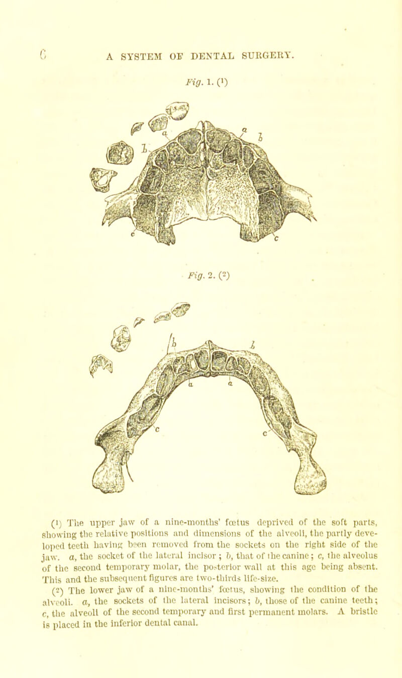 Fig. 1. (') (1) The upper jaw of a nine-months’ foetus deprived of the soft parts, showing the relative positions and dimensions of tlie alveoli, tlie partly deve- loped teeth having been removed from the sockets on tlie rlglit side of tlie jaw. a, the socket of tlie later.d incisor ; b, that of the canine; c, the alveolus of the second temporary molar, the posterior wall at tliis age being absent. Tliis and the subsequent figures are two-thirds life-size. (2) The lower jaw of a nine-months’ foetus, showing tlie condition of the alveoli, a, the sockets of the lateral Incisors; b, those of the c.anine teeth; c, the alveoli of the second temporary and first permanent molars. A bristle is placed in the inferior dental canal.