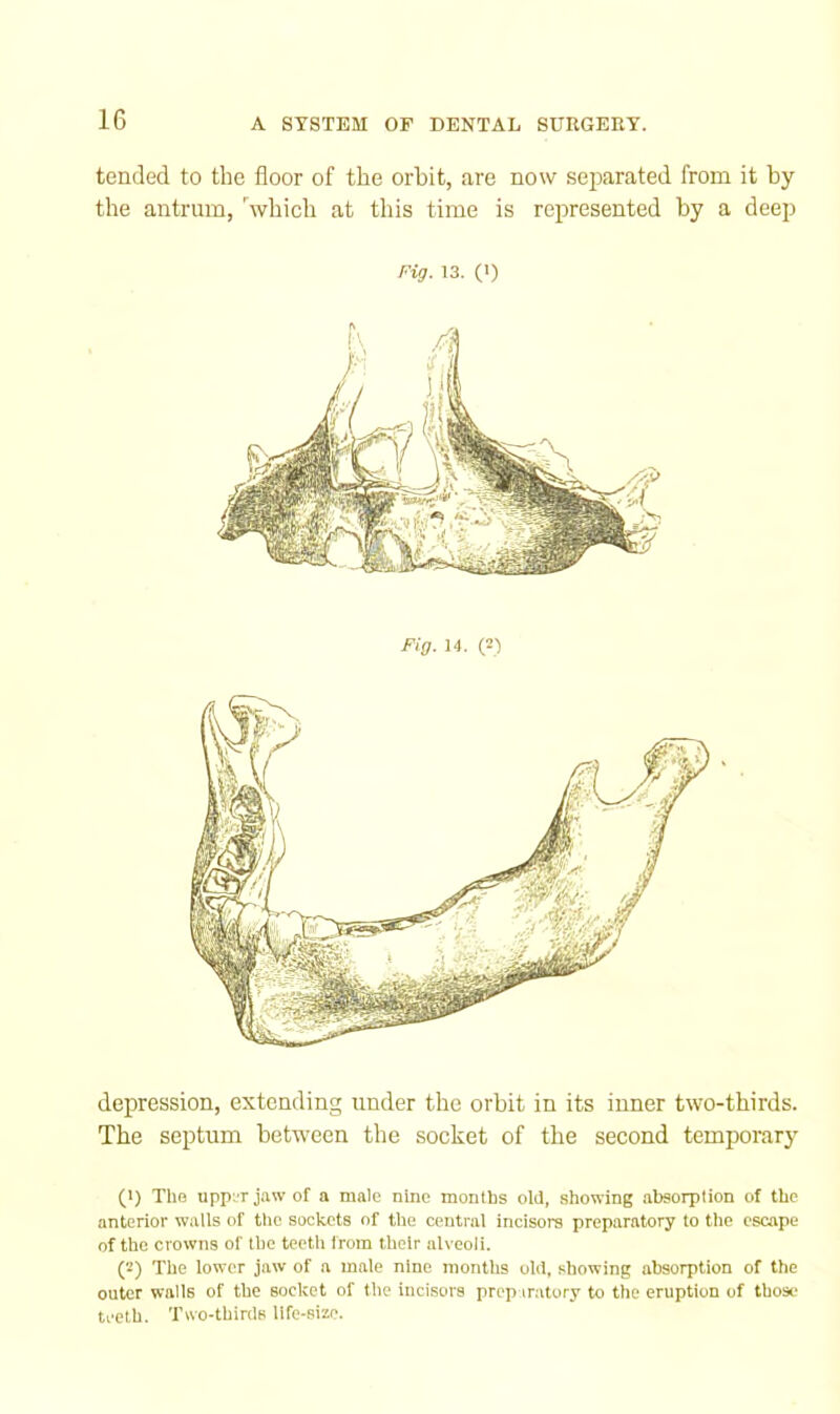 tended to the floor of the orbit, are now sejwated from it by the antrum, hvhich at this time is represented by a deep Pig- 13. (>) Fig. 14. (S') depression, extending under the orbit in its inner two-thirds. The septum between the socket of the second temporary (1) The upp;T jaw of a male nine monlbs old, showing absorption of the anterior walls of the sockets of the central incisors preparatory to tlic escape of the crowns of the teetli from their alveoli. (2) The lower jaw of a male nine months old, showing absorption of the outer walls of the socket of the incisors prep iratory to the eruption of those teeth. Two-thirds life-size.