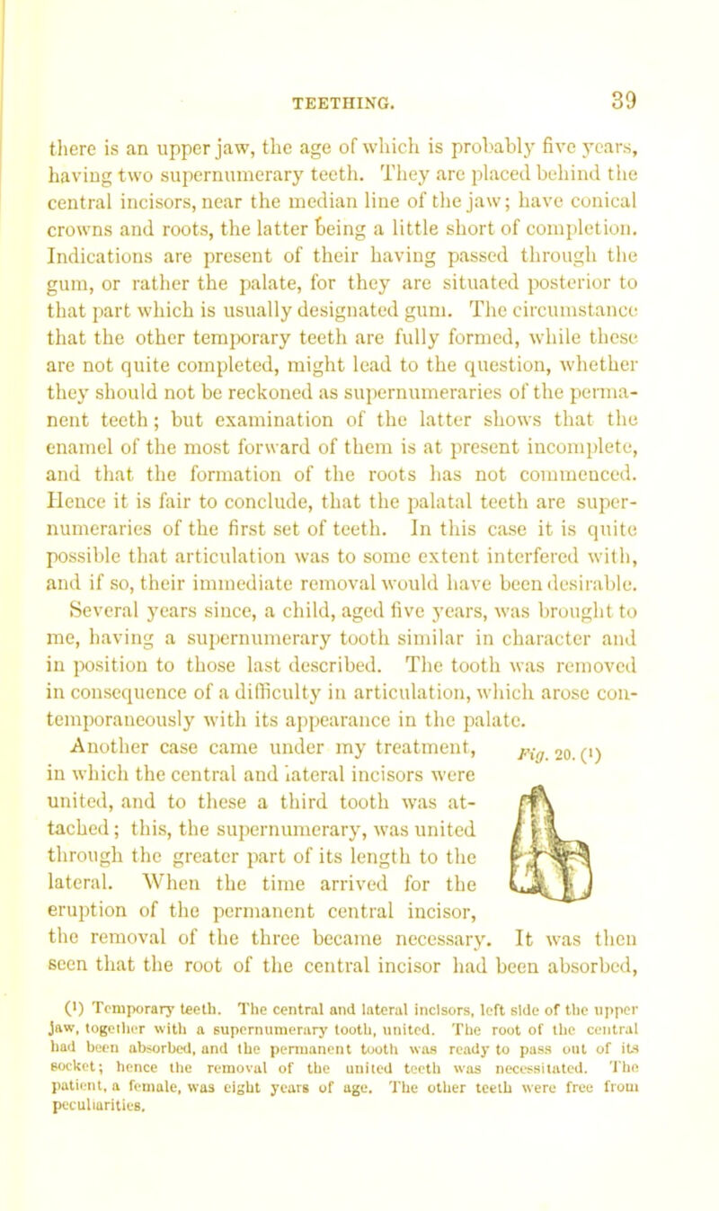 there is an upper jaw, the age of which is prohabl}’ five 3'cars, having two supernumerarj' teeth. They are placed behind the central incisors, near the median line of the jaw; have conical crowns and roots, the latter being a little short of completion. Indications are present of their having passed through the gum, or rather the palate, for they are situated posterior to that part which is usually designated gum. The circumstance that the other temjwrary teeth are fully formed, while these are not quite completed, might lead to the question, whether thej’ should not be reckoned as supernumeraries of the perma- nent teeth; but examination of the latter shows that the enamel of the most forward of them is at present incomplete, and that the formation of the roots has not commenced. Hence it is fair to conclude, that the palatal teeth are super- numeraries of the first set of teeth. In this case it is quite possible that articulation was to some extent interfered with, and if so, their immediate removal would have been desirable. Several j’cars since, a child, aged five 5’cars, was brought to me, having a supernumerary tooth similar in character and in position to those last described. The tooth was removed in consequence of a difficultj' in articulation, which arose con- temporaneously with its appearance in the palate. Another case came under my treatment, in which the central and lateral incisors were united, and to these a third tooth was at- tached ; this, the supernumerarjq was united through the greater part of its length to the lateral. When the time arrived for the eruption of the permanent central incisor, the removal of the three became necessary. It was then seen that the root of the central incisor had been absorbed, (*) (*) Temporary teeth. The central and lateral incisors, left side of the upper jaw, togeiluT with a supernumerary tooth, united. The root of the central had been absorbed, and the permanent tooth was ready to pas.s out of its socket; hence the removal of the united teeth was necessitated. The patient, a female, was eight years of age. The other teeth were free from peculiarities.