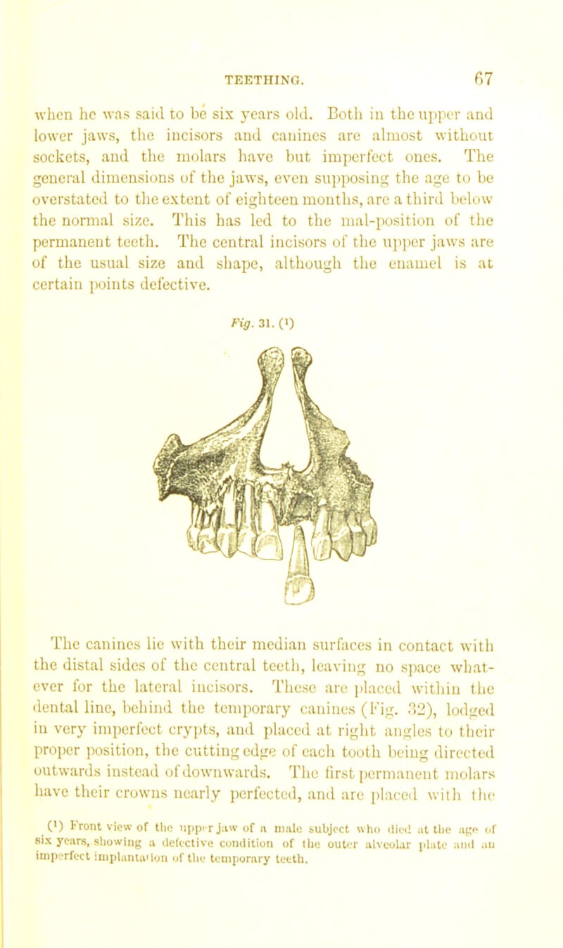 when he w<as said to be six 3’ears old. Both in the upper and lower jaws, the incisors and canines arc almost without sockets, and the molars have but imperfect ones. The general dimensions of the jaws, even supposing the age to be overstated to the extent of eighteen months, are a third below the normal size. This has led to the mal-pusition of the permanent teeth. The central incisors of the up]ier jaw's are of the usual size and shape, although the enamel is at certain points defective. Fig. 31. (1) The canines lie with their median surfirces in contact with the distal sides of the central teeth, leaving no space what- ever for the lateral incisors. These are jilaced within the dental line, behind the temporary canines (Fig. .32), lodged in very imperfect crypts, and placed at right angles to their proper position, the cutting edge of each tooth being directed outwards instead of downwards. The first permanent molars have their crowns nearly perfected, and are placed with the (') Front view of tlie nppi rjnw of n nmie iubjoct who died iit the ape of Bix years, showing a defective condition of the outer alveoUr j*lute and au imperfect impluntaMon of the temporary teeth.