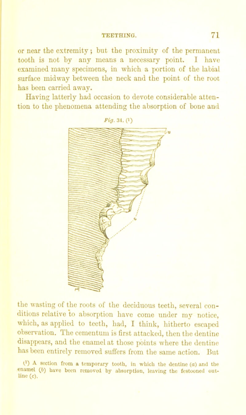 or near the extremity; but the proximity of the permanent tooth is not by any moans a necessary point. I have examined many specimens, in which a portion of the labial surface midway between the neck and the point of the root has been carried away. Having latterly had occasion to devote considerable atten- tion to the phenomena attending the absorption of bone and the wasting of the roots of the deciduous teeth, several con- ditions relative to absorjdion have come under my notice, which, as applied to teeth, had, I thiidi, hitherto escaped observation. The cementuni is first attacked, then the dentine disappears, and the enamel at those points where the dentine has been entirely removed sufl'ers from the same action. 15ut 0) A section from a temporary tooth, in which the dentine (a) and the enamel (6) have been removed by absorption, leaviiiK the festooned out- line (c). Fig. 34.(1)