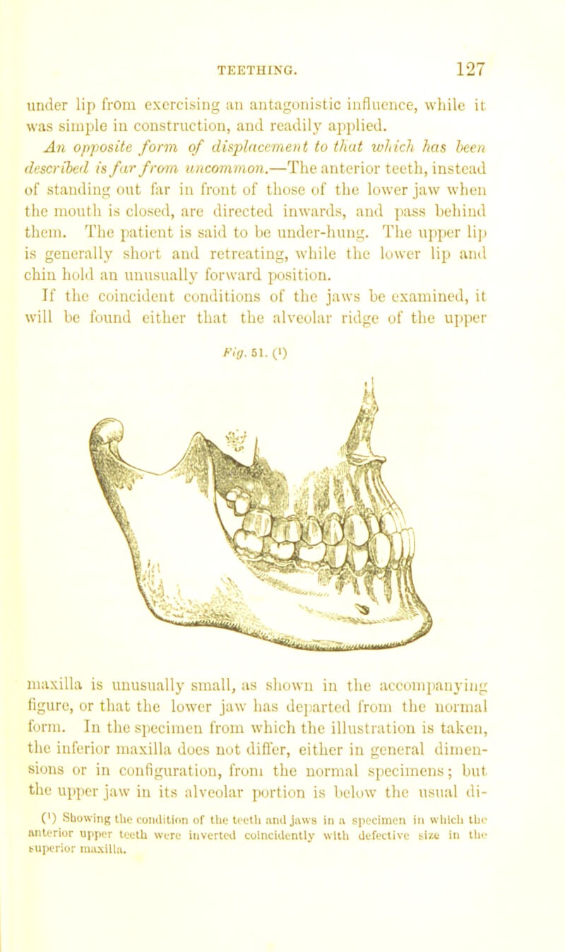 under lip from exercising an antagonistic influence, while it was simple in construction, and readily applied. An opposite form of displacement to that which has been described is far from uncommon.—The anterior teeth, instead of standing out for in front of those of the lower jaw when the mouth is closed, are directed inwards, and pass behind them. The patient is said to be under-hung. The upper lip is generally short and retreating, while the lower lip and chin hold an unusually forward position. If the coincident conditions of the jaws be examined, it will he found either that the alveolar ridge of the upper Ftg. 51. (>) maxilla is unusually small, as shown in the accompanying figure, or that the lower jaw has departed from the normal form. In the specimen from which the illustration is taken, the inferior maxilla does not difl'er, either in general dimen- sions or in configuration, from the normal specimens; but the upper jaw in its alveolar portion is below the usual di- (') Showing the condition of the teeth and jaws in a specimen in wlilch the anterior upper teeth were inverted coincidently wltli defective si/A- in the- buperior maxilla.