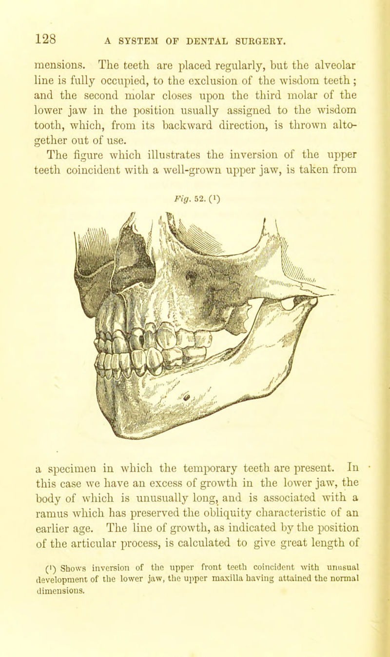 mensions. The teeth are placed regularly, hut the alveolar line is fully occupied, to the exclusion of the wisdom teeth; and the second molar closes upon the third molar of the lower jaw in the position usually assigned to the wisdom tooth, which, from its backward direction, is thrown alto- gether out of use. The figure which illustrates the inversion of the upper teeth coincident with a well-grown upper jaw, is taken from Fig. 52. (1) a specimen in which the temporary teeth are present. In • [ this case we have an excess of growth in the lower jaw, the I body of which is unusually long, and is associated with a j ramus which has preserved the obliquity characteristic of an earlier age. The line of growth, as indicated by the position , of the articular process, is calculated to give great length of ' (I) Shows inversion of the upper front teeth coincident with unusual development of tlie lower jaw, the upper maxilla having attained the normal dimensions. 1