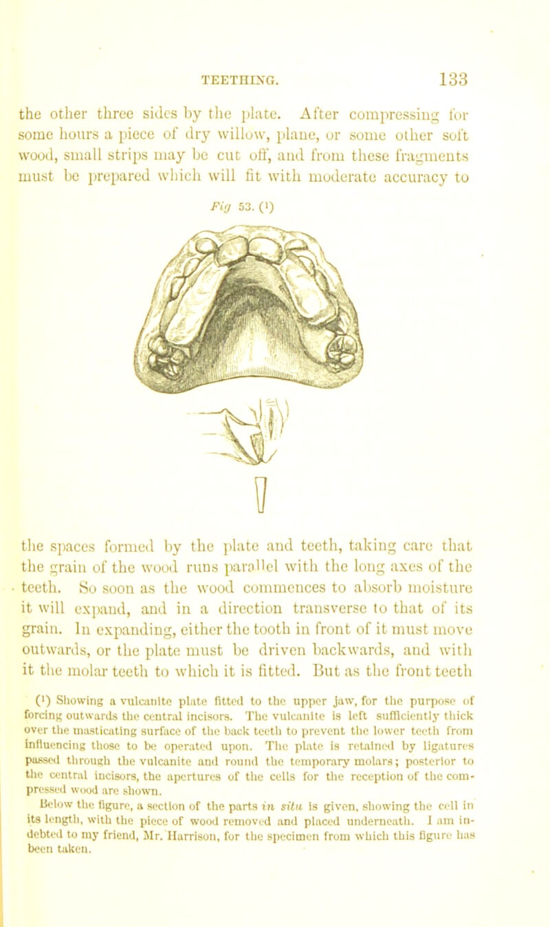 the other three sides by the plate. After compressing for some hours a piece of dry willow, plane, or some other soft wooel, small strips may be cut ofl', and from these fragments must be prepared which will fit with moderate accuracy to Fig 53. (I) H the spaces formed by the jdate and teeth, taking care that the grain of the wood runs parallel with the long axes of the teeth. So soon as the wood commences to absorb moisture it will expand, and in a direction transverse to that of its grain. In expanding, either the tooth in front of it must move outwards, or the plate must be driven backwards, and with it the molar teeth to which it is fitted. But as the front teeth (i) Sliowing a vulaiiiltc plate fitted to the upper jaw, for the purpose of forcing outwards the central incisors. The vulcanUc is left sufficiently tliick over the uuLsticating surface of the back teetli to prevent the lower teeth from Influencing those to be operated upon. The plate is retained by ligatures passfHl throuch the vulcanite and round the temporary molars; posterior to Ujc central incisors, the apertures of the cells for the reception of the com- pressed wood are shown. Below the figure, a section of the parts in situ Is given, showing the cell in its length, with the piece of wo‘xi removed and placed underneath. I am in- debted to my friend, Mr. Harrison, fur the specimen from which this figure bus been taken.