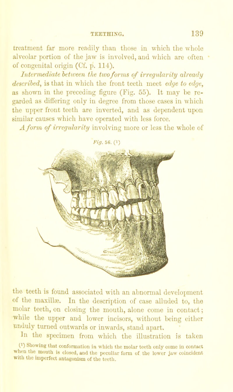 treatment far more readily tliaii tliose in whicli the whole alveolar portion of the jaw is involved, and which are often of congenital origin (C'f. p. 11-1). Intermediate between the two forms of irregular if 1/ already described, is that in which the front teeth meet edge to edge, as shown in the preceding figure (Fig. 55). It may be re- garded as differing only in degree from those cases in which the upper front teeth are inverted, and as deixmdent ujxin similar causes which have operated with less force. A form of irregularity involving more or less the whole of f'ig- 56. (>) the teeth is found associated with an abnormal development of the maxilhe. In the description of case alluded to, the molar teeth, on closing the mouth, alone come in contact; while the upper and lower incisors, without being cither unduly turned outwards or inwards, stand apart. In the specimen from which the illustration is taken (*) Showing tliat conformation in which the molar teeth only come in contact when the mouth is closed, aud Uie peculiar form of the lower jaw coincident with the imperfect antagonism of the teeth.