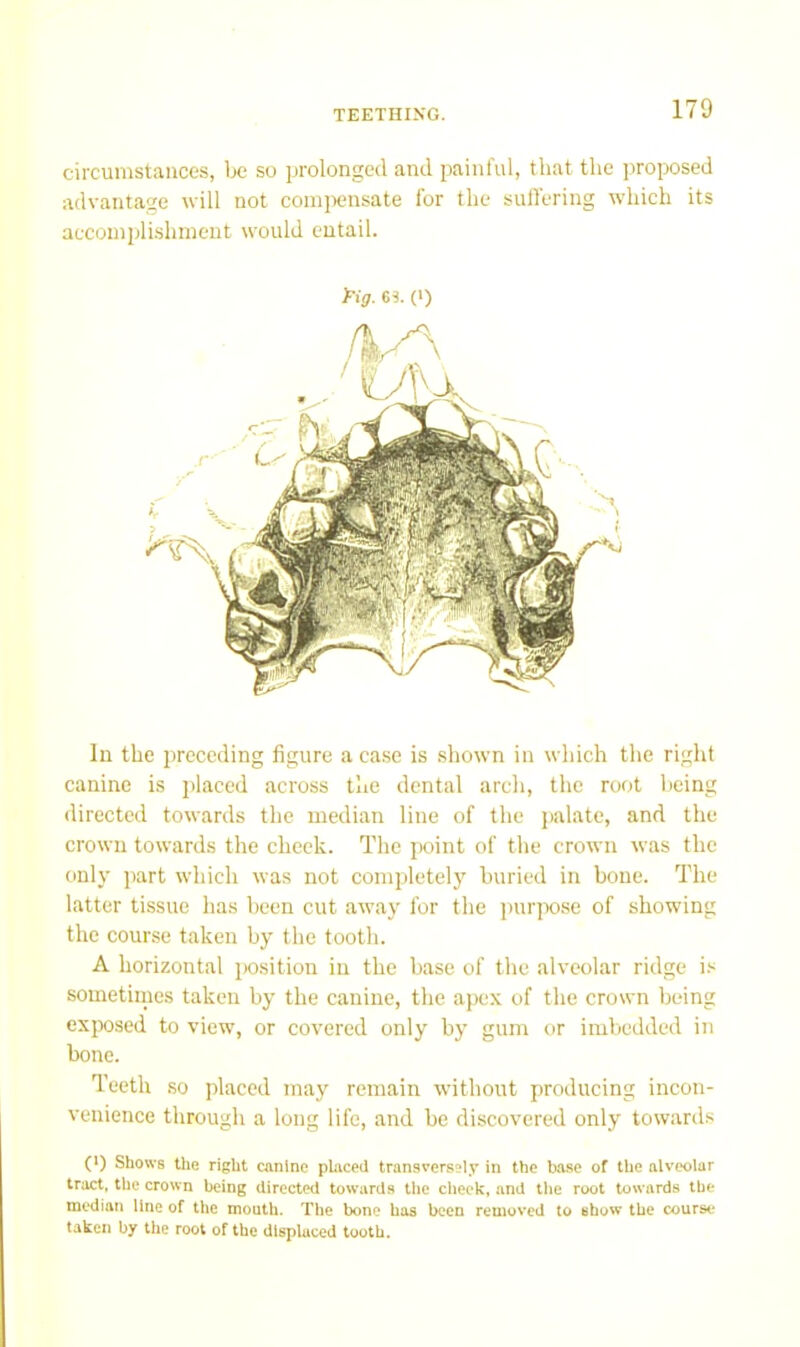 circumstances, lie so prolonged and painful, that the proposed advantage will not compensate for the suffering which its accomplishment would entail. fig. 6S. (•) In the jireccding figure a case is shown in which the right canine is placed across the dental arch, the root being directed towards the median line of the jialate, and the crown towards the cheek. The point of the crown was the only part which was not completely buried in bone. The latter tissue has been cut away for the ])urjx)se of showing the course taken by the tooth. A horizontal jKisition in the base of the alveolar ridge i.*^ sometiines taken by the canine, the apex of the crown being exjx)sed to view, or covered only by gum or imbedded in bone. Teeth SO placed may remain without producing incon- venience througli a long life, and be discovered only towards (i) Shows tlie right canine placed transversely in the base of the alveolar tract, the crown being directed towards the cheek, and the root towards the median line of the mouth. The bone has been removed to show the course taken by the root of the displaced tooth.