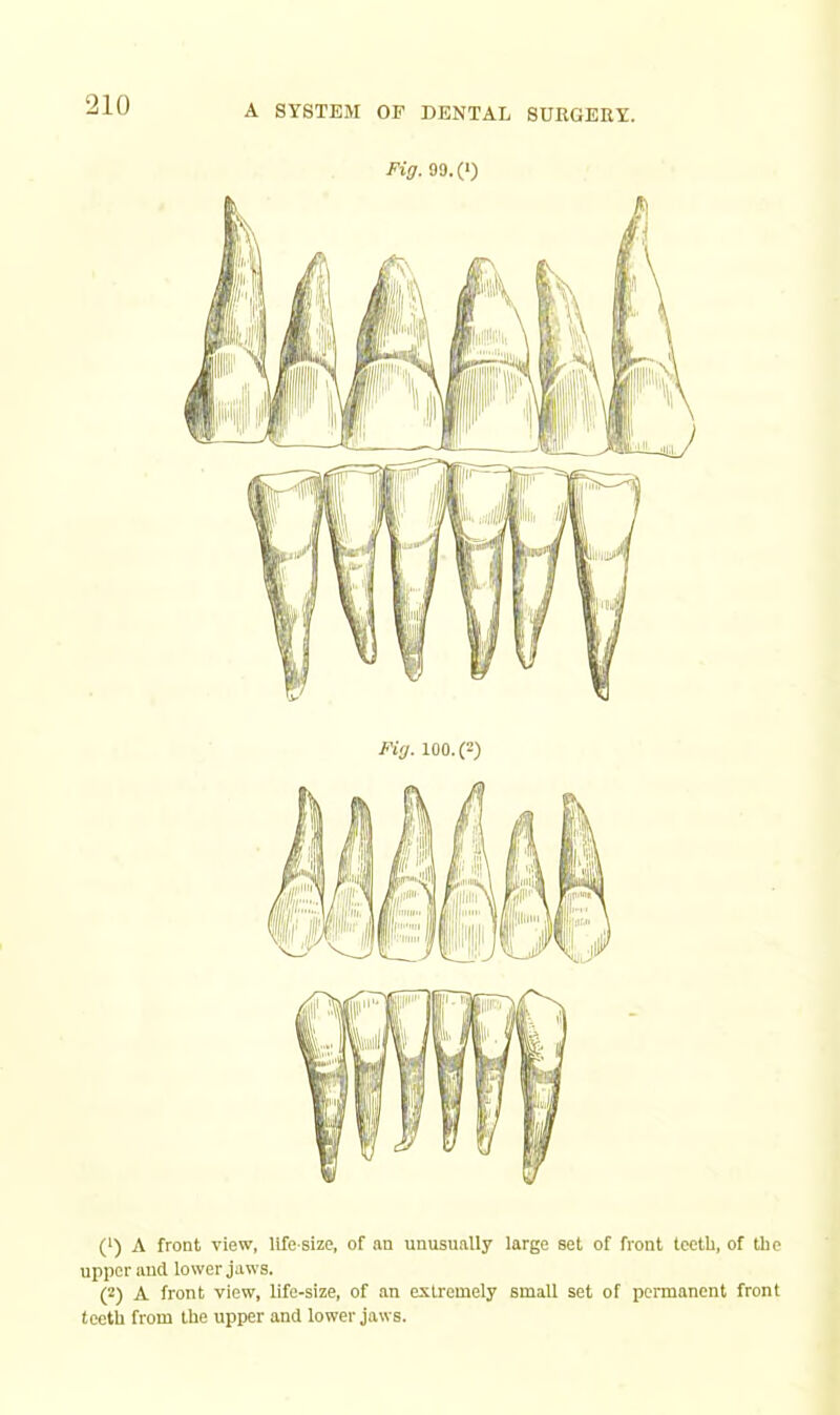 Fig. 99.(‘) Fig. 100.(2) (') A front view, life-size, of an unusually large set of front teeth, of the upper aud lower jaws. (2) A front view, life-size, of an extremely small set of permanent front teeth from the upper and lower jaws.