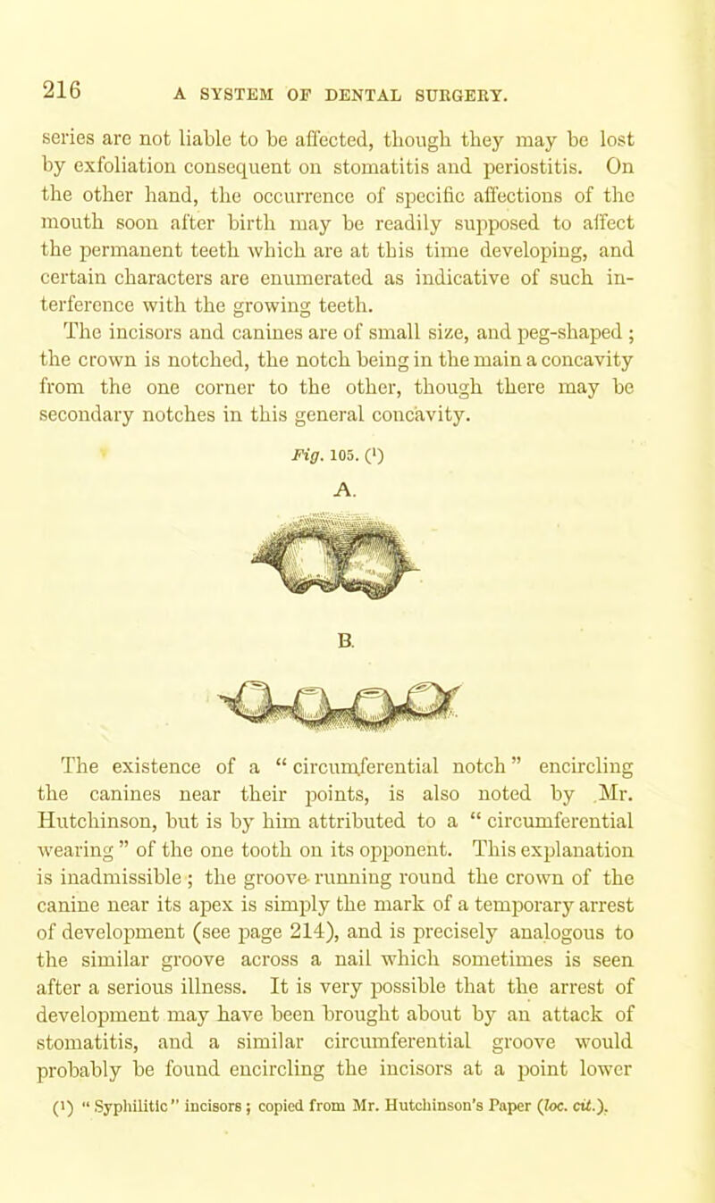 series are not liable to be affected, though they may bo lost by exfoliation consequent on stomatitis and periostitis. On the other hand, the occurrence of specific affections of the mouth soon after birth may be readily supposed to affect the permanent teeth which are at this time developing, and certain characters are enumerated as indicative of such in- terference with the growing teeth. The incisors and canines are of small size, and peg-shaped ; the crown is notched, the notch being in the main a concavity from the one corner to the other, though there may be secondary notches in this general concavity. Fig. 105. (') A. B. The existence of a “ circuinferential notch ” encircling the canines near their points, is also noted by .Mr. Hutchinson, but is by him attributed to a “ circumferential wearing ” of the one tooth on its opponent. This explanation is inadmissible ; tbe groove- running round the crown of the canine near its apex is simply the mark of a temporary arrest of development (see page 214), and is precisely analogous to the similar groove across a nail which sometimes is seen after a serious illness. It is very possible that the arrest of development may have been brought about by an attack of stomatitis, and a similar circumferential groove would probably be found encircling the incisors at a point lower (1) “ Sypliilitic” incisors; copied from Mr. Hutcliinson’s Paper (ioc. cii.).