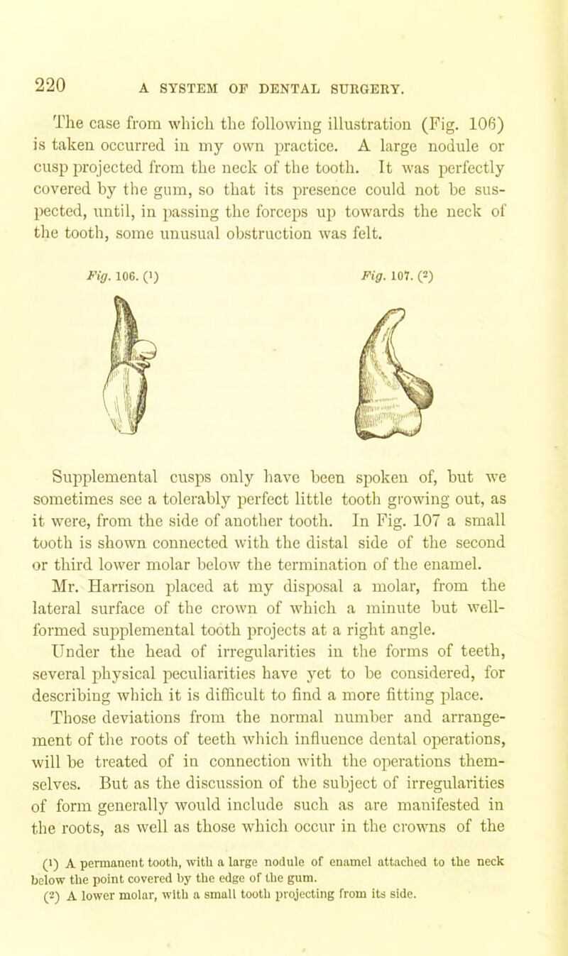 Tlie case from which the following illustration (Fig. 106) is taken occurred in my own practice. A large nodule or cusp projected from the neck of the tooth. It was j>erfectly covered by the gum, so that its presence could not be sus- pected, until, in passing the foreeps up towards the neck of the tooth, some unusnal obstruction was felt. Fig. 106. (1) Fig. lOY. (2) Supiilemental cusps only have been spoken of, but we sometimes see a tolerably perfect little tooth growing out, as it were, from the side of another tooth. In Fig. 107 a small tooth is shown connected with the distal side of the second or third lower molar below the termination of the enamel. Mr. Harrison placed at my disposal a molar, from the lateral surface of the crown of which a minute but well- formed sujiplemental tooth projects at a right angle. Under the head of irregularities in the forms of teeth, several physical peculiarities have yet to be considered, for describing which it is difficult to find a more fitting place. Those deviations from the normal number and arrange- ment of the roots of teeth which influence dental operations, will be treated of in connection with the operations them- selves. But as the discussion of the subject of irregularities of form generally would include such as are manifested in the roots, as well as those which occur in the crowns of the (1) A permanent tooth, with a large nodule of enamel attached to the neck below the point covered by the edge of the gum. (2) A lower molar, with a small tooth projecting from its side.