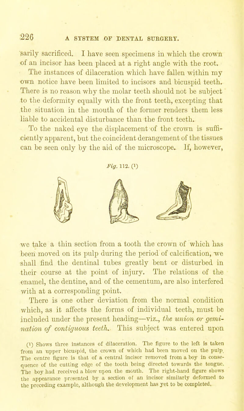 sarily sacrificed. I have seen specimens in which the crown of an incisor has heen jdaced at a right angle with the root. The instances of dilaceration which have fallen within my own notice have heen limited to incisors and bicuspid teeth. There is no reason why the molar teeth should not he subject to the deformity equally with the front teeth, excepting that the situation in the mouth of the former renders them less liable to accidental disturbance than the front teeth. To the naked eye the displacement of the crown is suffi- ciently api^arcnt, hut the coincident derangement of the tissues can be seen only by the aid of the microscope. If, however. Fig. 112. (>) we take a thin section from a tooth the crown of which has heen moved on its pulp during the jieriod of calcification, we shall find the dentinal tubes greatly bent or disturbed in their course at the point of injury. The relations of the enamel, the dentine, and of the cementum, are also interfered with at a corresponding point. There is one other deviation from the normal condition which, as it affects the forms of individual teeth, must he included under the present heading—viz., the union or gemi- nation of contiguous teeth. This subject was entered upon (1) Shows three instances of dilaceration. The figure to the left is taken from an upper bicuspid, the crown of which had been moved on the pulp. The centre figure is that of a central incisor removed Irom a hoy in conse- quence of the cutting edge of the tooth being directed towards the tongue. The hoy had received a blow upon the mouth. The right-hand figure shows the .appearance presented by a section of an incisor similarly deformed to the preceding example, although the development has yet to be completed.